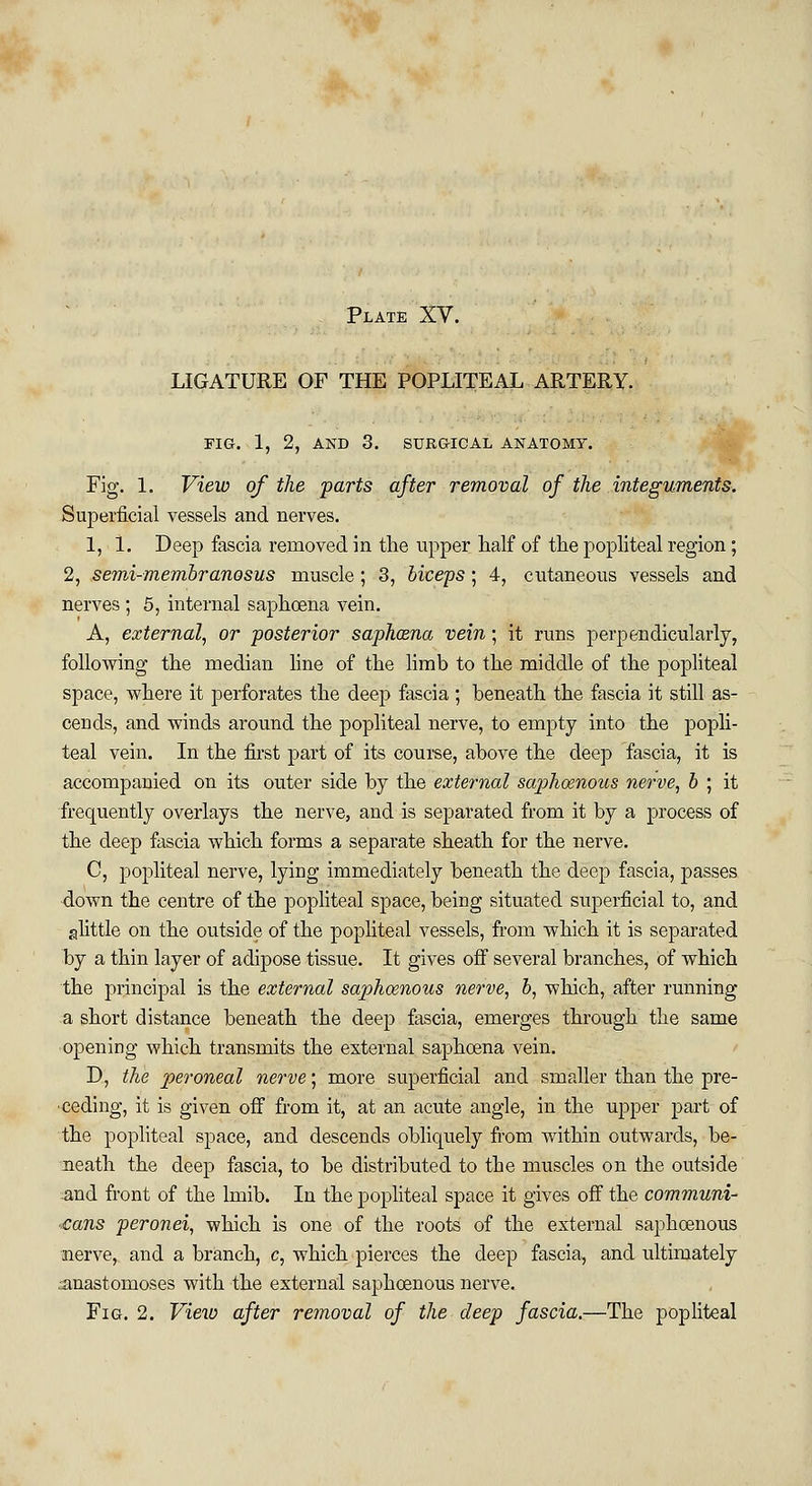 LIGATURE OF THE POPLITEAL ARTERY. FIG. 1, 2, AND 3. SURGICAL ANATOMY. Fig. 1. View of the farts after removal of the integuments. Superficial vessels and nerves. 1, 1. Deep fascia removed in the upper half of the popliteal region; 2, semi-membranosus muscle ; 3, biceps ; 4, cutaneous vessels and nerves ; 5, internal saphcena vein. A, external, or posterior saph&na vein; it runs perpendicularly, following the median line of the limb to the middle of the popliteal space, where it perforates the deep fascia ; beneath the fascia it still as- cends, and winds around the popliteal nerve, to empty into the popli- teal vein. In the first part of its course, above the deep fascia, it is accompanied on its outer side by the external saphoenous nerve, b ; it frequently overlays the nerve, and is separated from it by a process of the deep fascia which forms a separate sheath for the nerve. C, popliteal nerve, lying immediately beneath the deep fascia, passes down the centre of the popliteal space, being situated superficial to, and alittle on the outside of the popliteal vessels, from which it is separated by a thin layer of adipose tissue. It gives off several branches, of which the principal is the external saphoenous nerve, b, which, after running a short distance beneath the deep fascia, emerges through the same opening which transmits the external saphcena vein. D, the peroneal nerve; more superficial and smaller than the pre- ceding, it is given off from it, at an acute angle, in the upper part of the popliteal space, and descends obliquely from within outwards, be- neath the deep fascia, to be distributed to the muscles on the outside and front of the lmib. In the popliteal space it gives off the communi- ■cans peronei, which is one of the roots of the external saphoenous nerve, and a branch, c, which pierces the deep fascia, and ultimately anastomoses with the external saphoenous nerve. Fig. 2. View after removal of the deep fascia.—The popliteal