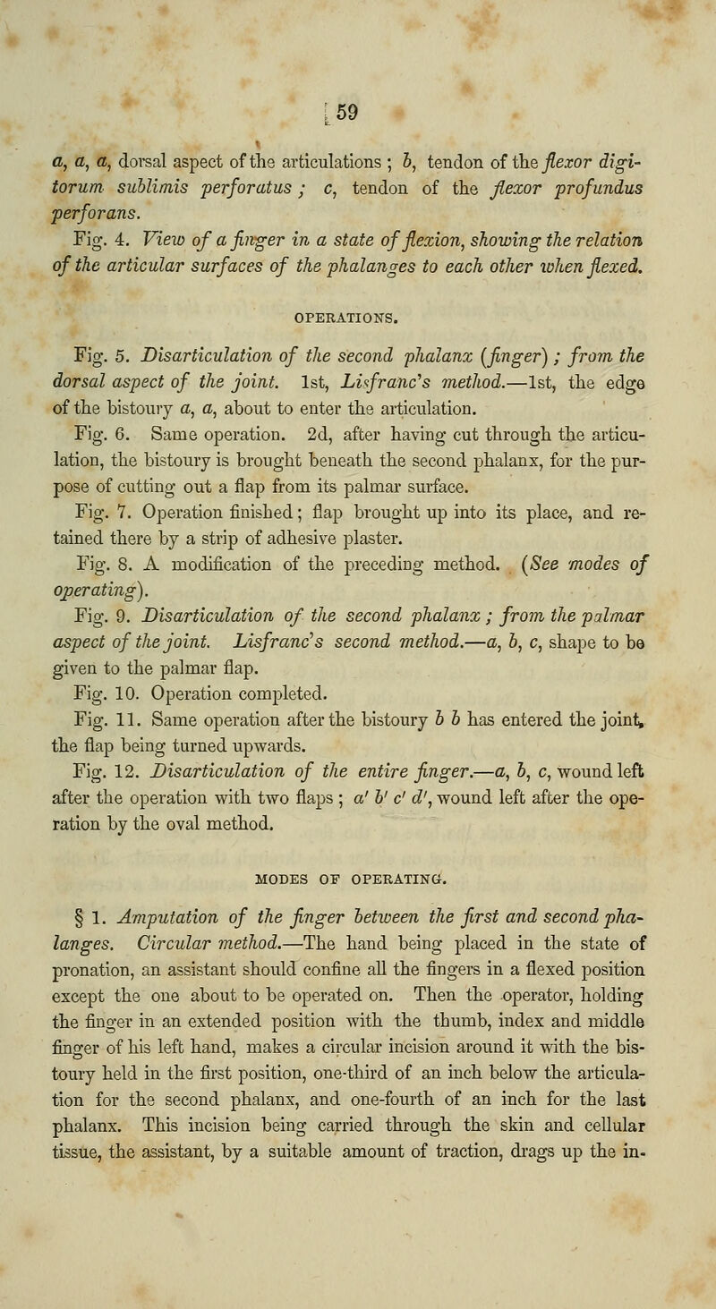 :59 a, a, a, dorsal aspect of the articulations ; b, tendon of the flexor digi- torum sublimis perforatus ; c, tendon of the flexor profundus perforans. Fig. 4. View of a finger in a state of flexion, showing the relation of the articular surfaces of the phalanges to each other when flexed. OPERATIONS. Fig. 5. Disarticulation of the second phalanx (finger); from the dorsal aspect of the joint. 1st, Lisfranc's method.—1st, the edge of the bistoury a, a, about to enter the articulation. Fig. 6. Same operation. 2d, after having cut through the articu- lation, the bistoury is brought beneath the second phalanx, for the pur- pose of cutting out a flap from its palmar surface. Fig. 7. Operation finished; flap brought up into its place, and re- tained there by a strip of adhesive plaster. Fig. 8. A modification of the preceding method. (See modes of operating). Fig. 9. Disarticulation of the second phalanx ; from the palmar aspect of the joint. Lisfranc's second method.—<z, 6, c, shape to be given to the palmar flap. Fig. 10. Operation completed. Fig. 11. Same operation after the bistoury b b has entered the joint* the flap being turned upwards. Fig. 12. Disarticulation of the entire finger.—a, &, c, wound left after the operation with two flaps ; a' b' c' d', wound left after the ope- ration by the oval method. MODES OF OPERATING. § 1. Amputation of the finger between the first and second pha- langes. Circular method.—The hand being placed in the state of pronation, an assistant should confine all the fingers in a flexed position except the one about to be operated on. Then the operator, holding the finger in an extended position with the thumb, index and middle finger of his left hand, makes a circular incision around it with the bis- toury held in the first position, one-third of an inch below the articula- tion for the second phalanx, and one-fourth of an inch for the last phalanx. This incision being carried through the skin and cellular tissue, the assistant, by a suitable amount of traction, drags up the in-