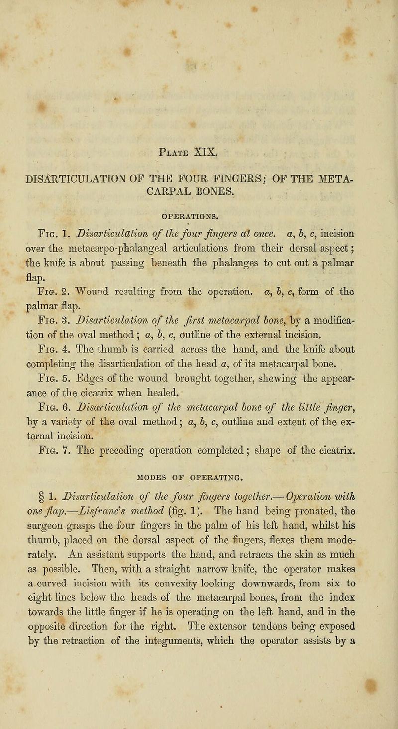 DISARTICULATION OF THE FOUR FINGERS; OF THE META- CARPAL BONES. OPERATIONS. Fig. 1. Disarticulation of the four fingers at once, a, 6, c, incision over the metacarpophalangeal articulations from their dorsal aspect; the knife is about passing beneath the phalanges to cut out a palmar flap. Fig. 2. Wound resulting from the operation, a, 6, c, form of the palmar flap. Fig. 3. Disarticulation of the first metacarpal hone, by a modifica- tion of the oval method ; a, b, c, outline of the external incision. Fig. 4. The thumb is carried across the hand, and the knife about completing the disarticulation of the head a, of its metacarpal bone. Fig. 5. Edges of the wound brought together, shewing the appear- ance of the cicatrix when healed. Fig. 6. Disarticulation of the metacarpal bone of the little finger, by a variety of the oval method; a, b, c, outline and extent of the ex- ternal incision. Fig. 7. The preceding operation completed; shape of the cicatrix. MODES OF OPERATING. § 1. Disarticulation of the four fingers together.— Operation with one flap.—Lisfranc's method (fig. 1). The hand being pronated, the surgeon grasps the four fingers in the palm of his left hand, whilst his thumb, placed on the dorsal aspect of the fingers, flexes them mode- rately. An assistant supports the hand, and retracts the skin as much as possible. Then, with a straight narrow knife, the operator makes a curved incision with its convexity looking downwards, from six to eight lines below the heads of the metacarpal bones, from the index towards the little finger if he is operating on the left hand, and in the opposite direction for the right. The extensor tendons being exposed by the retraction of the integuments, which the operator assists by a