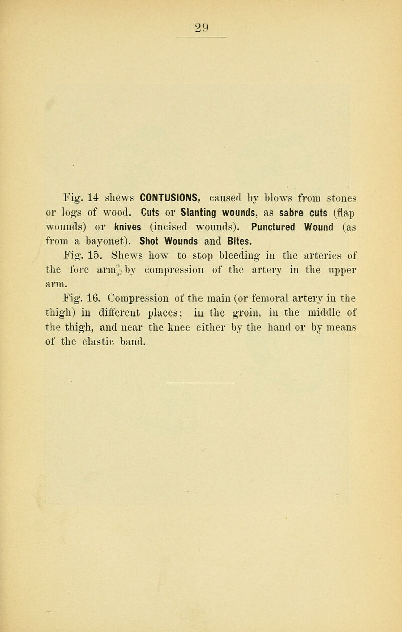 Mg\ 14 shews CONTUSIONS, caused by blows from stones or logs of wood. Cuts or Slanting wounds, as sabre cuts (flap wounds) or knives (incised wounds). Punctured Wound (as from a bayonet). Shot Wounds and Bites. Fig. 15. Shews how to stop bleeding* in the arteries of the fore arm^'; by compression of the artery in the upper arm. Fig'. 16. Compression of the main (or femoral artery in the thigh) in different places: in the groin, in the middle of the thigh, and near the knee either by the hand or by means of the elastic band.