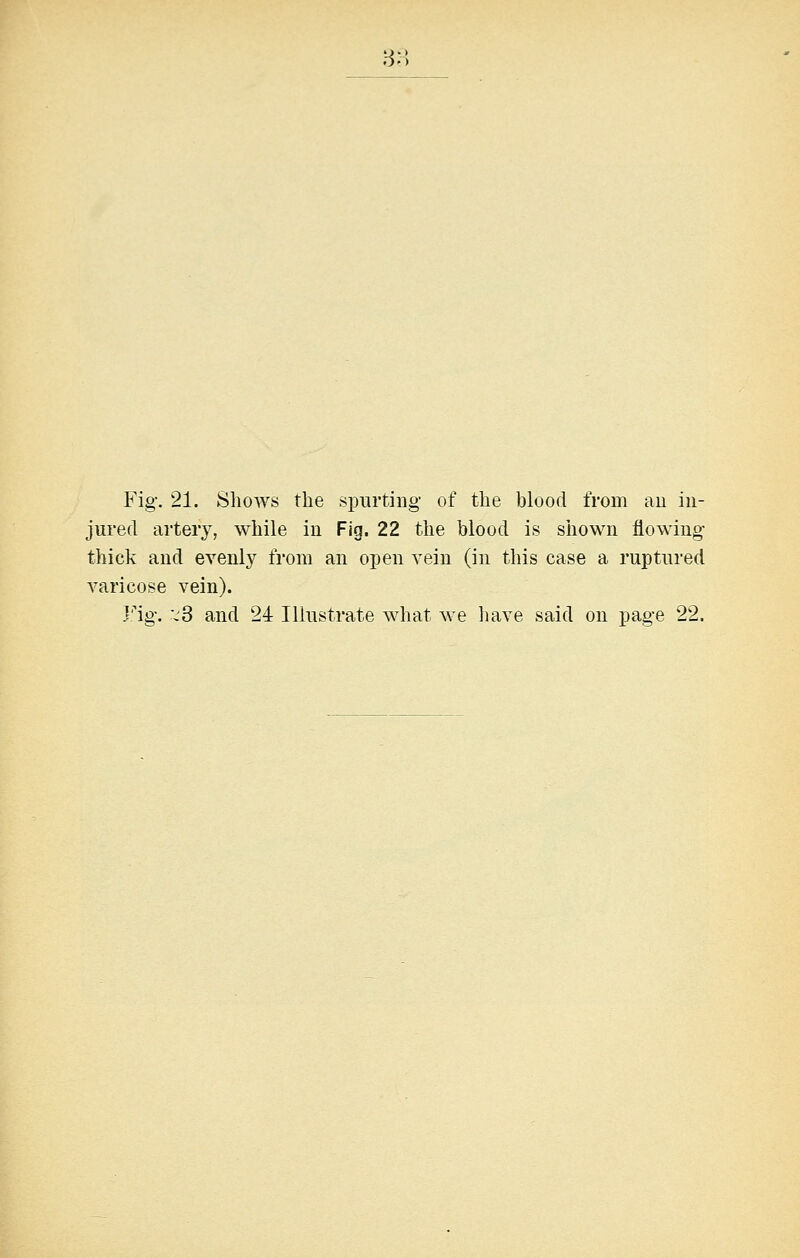 38 Fig. 21. Shows the spurting' of the blood from au in- jured artery, while in Fig. 22 the blood is shown flowing thick and evenly from an open vein (in this case a ruptured varicose vein). Fig. v3 and 24 Illustrate what we liave said on page 22.