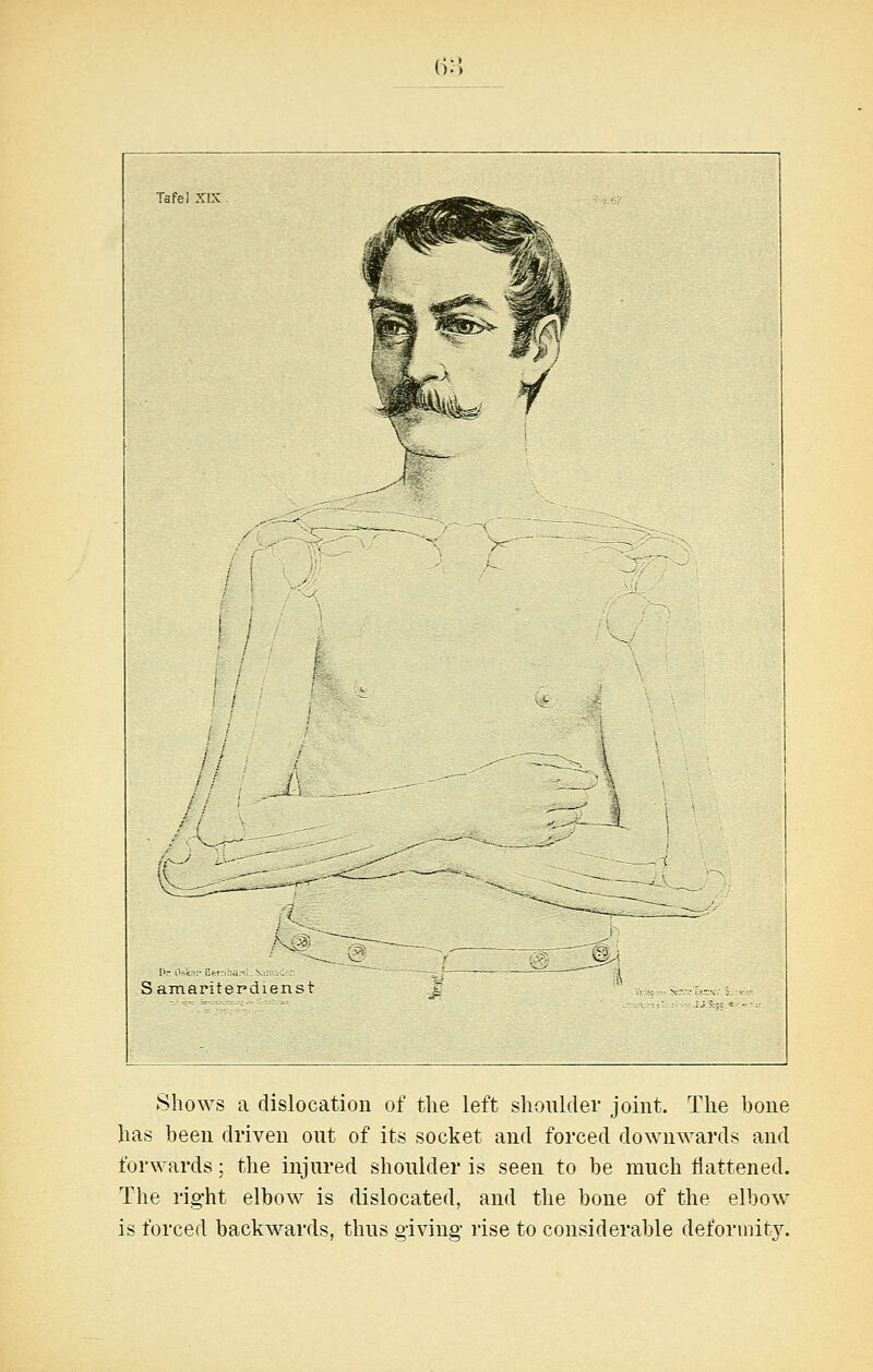 (i:') :7: a 1 t Saniariterdienst Shows a dislocation of tiie left shoulder joint. The bone has been driven out of its socket and forced downwards and forwards; the injured shoulder is seen to be much flattened. The right elbow is dislocated, and the bone of the elbow is forced backwards, thus giving- rise to considerable deformity.