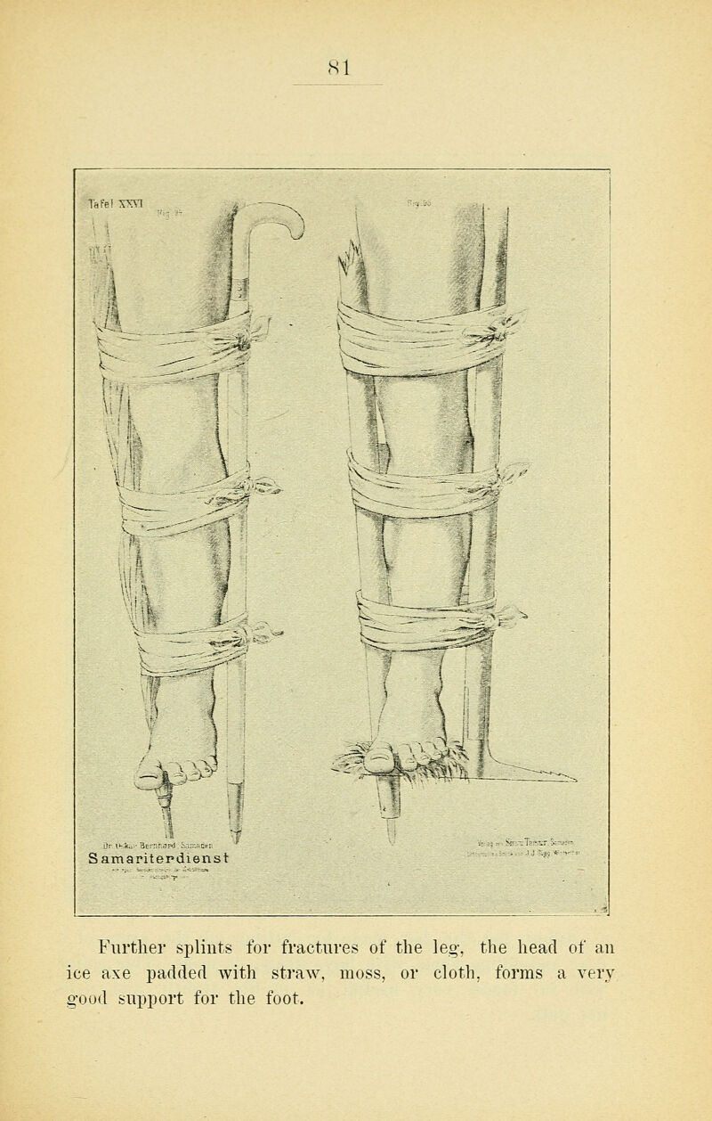 <S1 ^ ^^ ]■ Samaritepdienst Vi Further splints for fractures of the leg, the head of an ice axe padded with straw, moss, or cloth, forms a very good support for the foot.