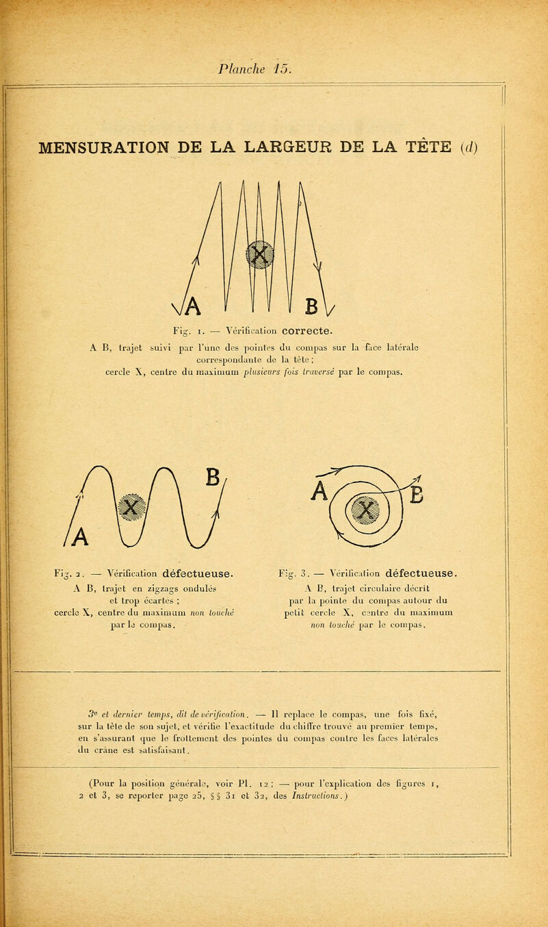 MENSURATION DE LA LARGEUR DE LA TÈTE {d) Fig-. I. — Vérification correcte. A B, trajet suivi par l'une des pointes du compas sur la lace latérale correspondante de la tète ; cercle X, centre du maximum plusieurs fois traversé par le compas. Fi-i-, 2. — Vérification défectueuse. A B, trajet en zigzags ondulés et trop écartés ; cercle X, centre du maximum non louché par le compas. Fig. 3. — Vérification défectueuse. A B, trajet circulaire déciit par la pointe du compas autour du petit cercle X, centre du maximum non louché par le compas. 5^ el dernier temps, dit de vérification. — Il replace le compas, une fois fixé, sur la tète de son sujet, et vérifie l'exactitude du chill're trouvé au premier temps, en s'assurant que le frottement dos pointes du compas contre les faces latérales du crâne est satisfaisant. (Pour la position générale, voir PI. 12; — pour l'explication des figures i, 2 et 3, se reporter page 26, §§ 3i et Sa, des Instructions.)