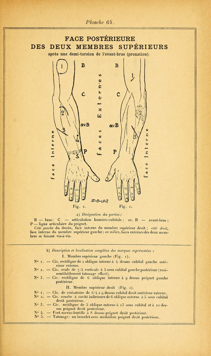FACE POSTÉRIEURE DES DEUX MEMBRES SUPÉRIEURS après une demi-torsion de l'avant-bras (pronation). a) Désignation des parties ; B — bras ; C — articulation Luméro-cubitale ; av. B — avant-bras ; P — ligne articulaire du poignet. Côté gauche du dessin, face interne du membre supérieur droit ; côté droit, face interne du membre supérieur gauche ; au mj7ie«, faces externes des deux mem- bres se faisant vis-à-vis. b) N» I. — N 2. N° 3. — No N I. — No 3. — No No 5. — Description et localisation complètes des marques représentées : I. Membre supérieur gauche (Fig. i). Cic. rectiligne de 2 oblique interne à 4 desius cubital gauche anté- rieur externe. Cic. ovale de ']/[\ verticale à 5 sous cubital gauche postérieur (vrai- semblablement tatouage effacé). Cic. rectiligne de G oblique interne à 9 dessus poignet gauche postérieur. II. Membre supérieur droit (Fig. 2). Cic. de vésicatoire de 6//1 à g dessus cubital droit antérieur externe. Cic. courbe à cavité inférieure de 6 oblique externe à 5 sous cubital droit postérieur. Cic. rectiligne de 5 oblique externe à i3 sous cubital et à iodes- sus poignet droit postérieur. Fort nœvus-lenlille à 8 dessus poignet droit postérieur. Tatouage : un bracelet avec médaillon poignet droit postérieur.