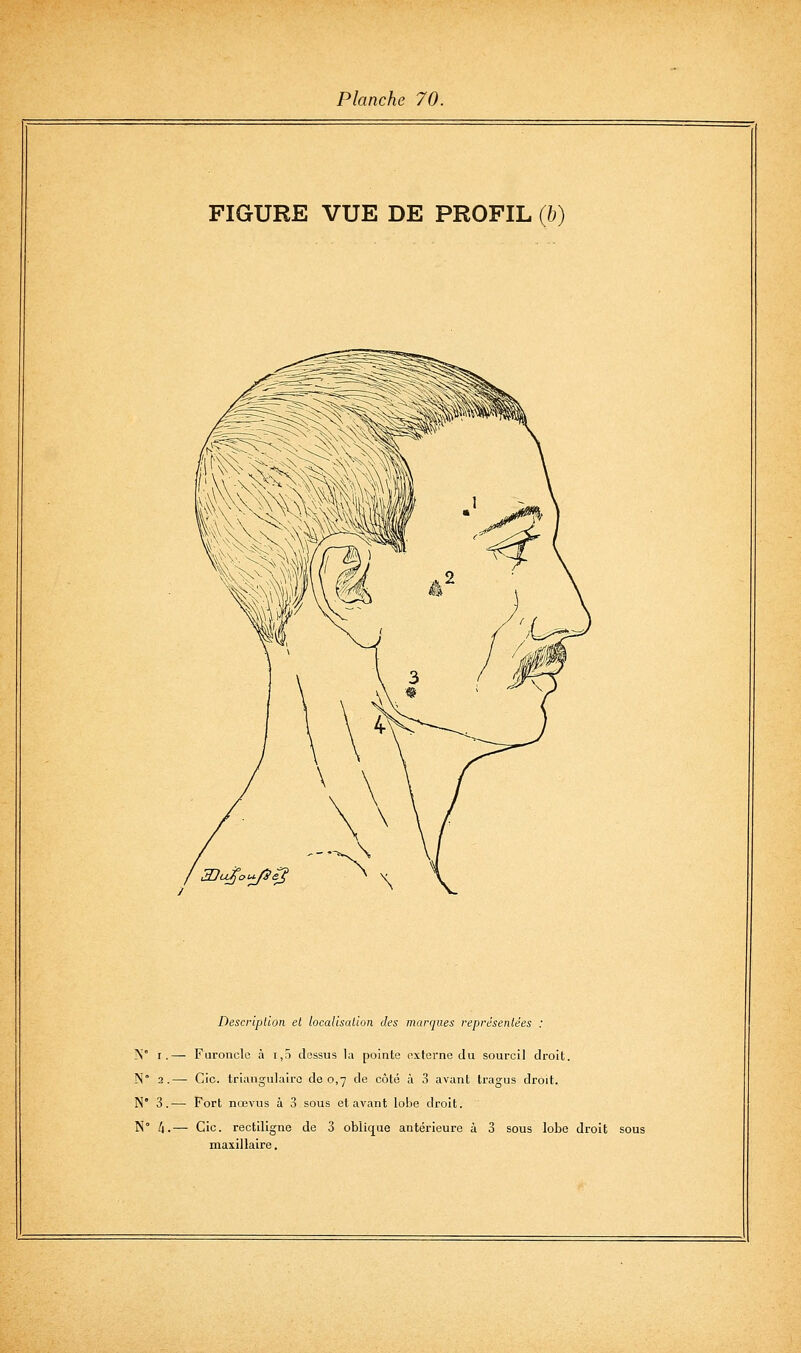 FIGURE VUE DE PROFIL {h) Description et localisalion des marques représentées : ]\° I.— Furoncle à i,5 dessus la pointe externe du sourcil droit. N° 2.— Cic. triangulaire de 0,7 de côté à 3 avant tragus droit. N' 3.— Fort nœvus à 3 sous et avant lobe droit. N° /j.— Cic. rectiligne de 3 oblicfue antérieure à 3 sous lobe droit sous maxillaire.