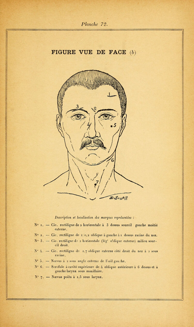 FIGURE VUE DE FACE (h) Description et localisation des marques représentées : N° I. — Cic. rectiligne de 2 horizontale à 3 dessus sourcil gauche moitié externe. N° 2. — Cic. rectiligne de i/o,a oblique à gauche à i dessus racine du nez. N 3. — Cic. rectiligne dj 2 horizontale (lég' oblique esterne) milieu sour- cil droit. N° 4. — Cic. rectiligne de 1,7 oblique externe côté droit du nez à 2 sous racine. j\* 5. — Nœvus à 2 sous anglij externe de l'œil gaujhe. M 6. — Scrofule à cavité supérieure de 4 oblique antérieure à 6 dessus et à gauche larynx sous maxillaire. N° 7. — Nœvus poilu à i,5 sous larynx.