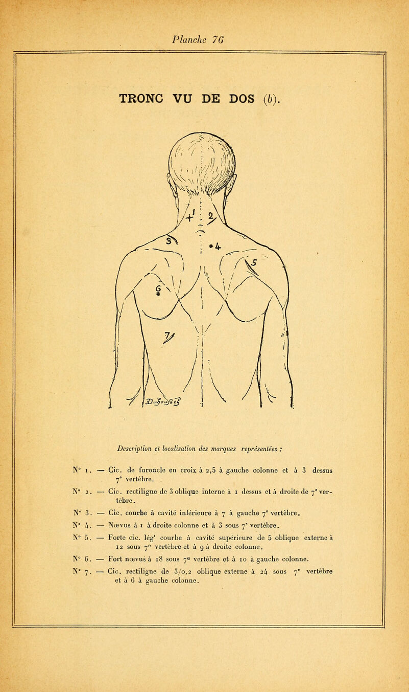 TRONC VU DE DOS (b). Description et localisation des marques représentées : N» 1. N 2. N 3. N° h. N° 5. N° C. N° 7- Cic. de furoncle en croix à 2,5 à gauche colonne et à 3 dessus 7° vertèbre. Cic. rectiligne de 3 oblique interne à i dessus et à droite de 7° ver- tèbre . Cic. courbe à cavité inférieure à 7 à gauche 7° vertèbre. Nœvus à I à droite colonne et à 3 sous 7' vertèbre. Forte cic. lég' courbe à cavilc supérieure de 5 oblique externe à 12 sous 7** vertèbre et à 9 à droite colonne. Fort nœvus à 18 sous 7^ vertèbre et à 10 à gauche colonne. Cic. rectiligne de 3/o,2 oblique externe à 24 sous 7° vertèbre et ù 6 à ifauche colonne.