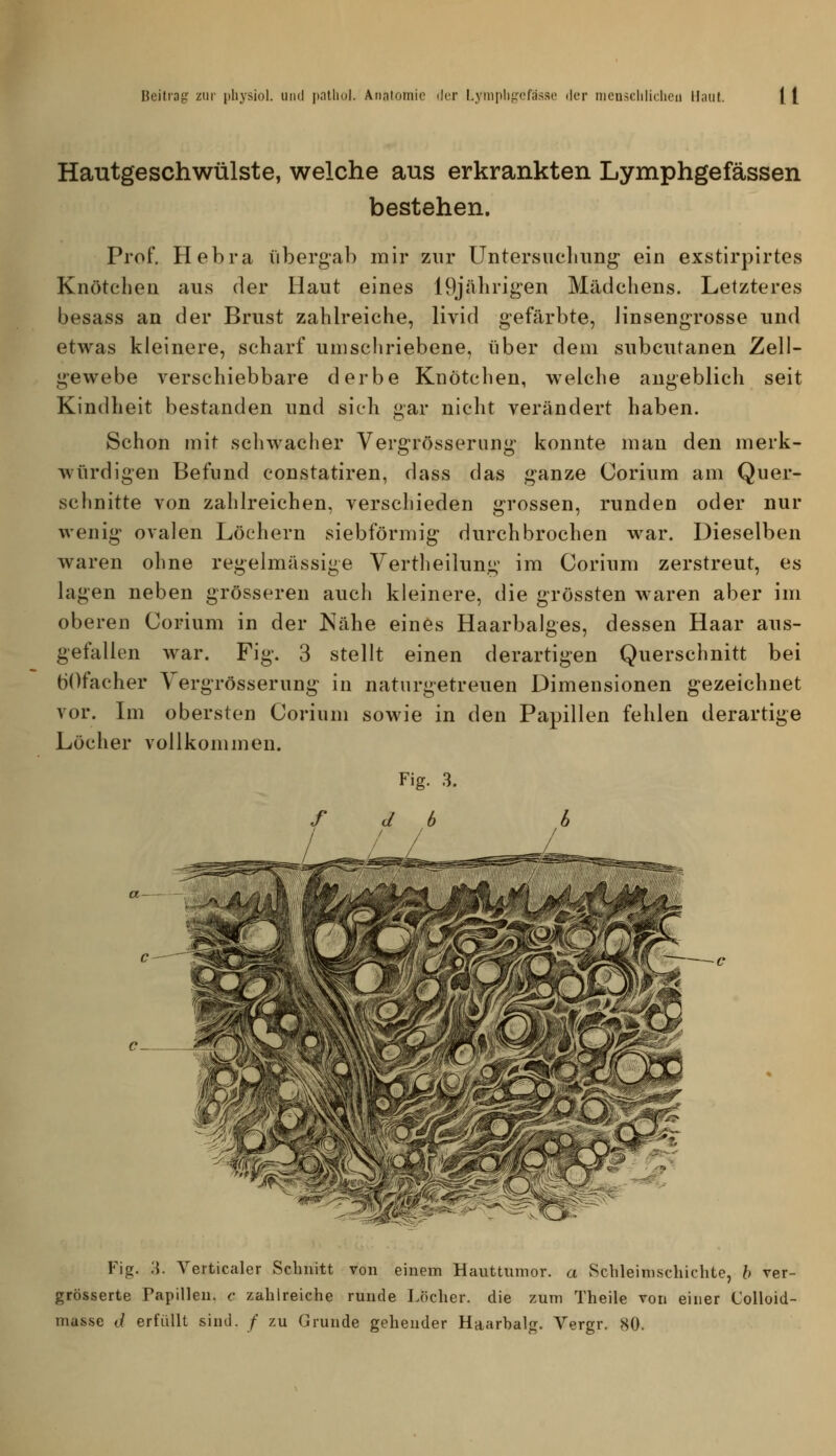 Hautgeschwülste, welche aus erkrankten Lymphgefässen bestehen. Prof. Hebra übergab mir zur Untersuclnmg ein exstirpirtes Knötchen aus der Haut eines 19jäbrigen Mädchens. Letzteres besass an der Brust zahh'eiche, livid gefärbte, Jinsengrosse und etwas kleinere, scharf umschriebene, über dem subcutanen Zell- gewebe verschiebbare derbe Knötchen, welche angeblich seit Kindheit bestanden und sich gar nicht verändert haben. Schon mit schwacher Vergrössernng konnte man den merk- würdigen Befund constatiren, dass das ganze Corium am Quer- schnitte von zahlreichen, verschieden grossen, runden oder nur wenig ovalen Löchern siebförmig durchbrochen war. Dieselben waren ohne regelmässige Vertheilung im Corium zerstreut, es lagen neben grösseren auch kleinere, die grössten waren aber im oberen Corium in der Nähe eines Haarbalges, dessen Haar aus- gefallen war. Fig. 3 stellt einen derartigen Querschnitt bei tiOfacher Yergrösserung in naturgetreuen Dimensionen gezeichnet vor. Lii obersten Corium sowie in den Papillen fehlen derartige Löcher vollkommen. Fig. 3. C- Fig. 3. Verticaler Schnitt von einem Haiittumor. a Scbleinischichte, h ver- grösserte Papillen, c zahlreiche runde Löcher, die zum Theile von einer Colloid- masse d erfüllt sind. / zu Grunde gehender Haarbalg. Vergr. 80.