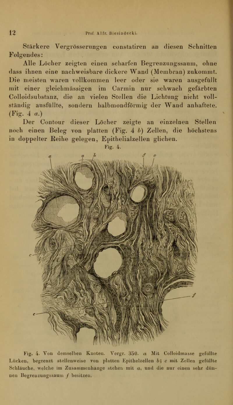 Stärkere Vergrösseriingeii constatiren aii diesen Schnitten Folgendes: Alle Löcher zeigten einen scharfen Begreiizungssaum, ohne dass ihnen eine nachweisbare dickere Wand (Membran) zukommt. Die meisten waren vollkommen leer oder sie waren ausgefüllt mit einer gleichmässigen im Carmin nur schwach gefärbten Colloidsubstanz, die an vielen Stellen die Lichtung* nicht voll- ständig- ausfüllte, sondern halbmondförmig der Wand anhaftete. (Fig. 4 a.) Der Contour dieser Löcher zeigte an einzelnen Stellen noch einen Beleg von platten (Fig. 4 b) Zellen, die höchstens in doppelter Reihe gelegen, Epithelialzellen glichen. Fig. 4. a ,3 ./■ & Fig. 4. Voll demselben Knoten. Vergr. 350. a Mit Colloidmasse gefüllte Lücken, begrenzt stellenweise von platten Epithelzellen 6; c mit Zollen gefüllte Schläuche, welche im Zusammenhange stehen mit a, und die nur einen sehr dün- nen Begreuzungssaum f besitzen.