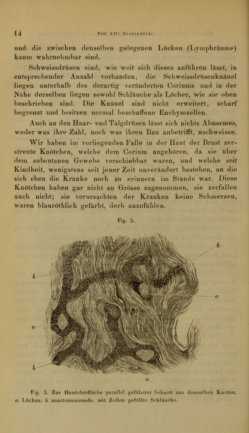 und die zwischen denselben gelegenen Lücken (Lyniplirrmme) kanni wahrnehmbar sind. Schweissdrüsen sind, wie weit sich dieses anführen lässt, in entsprechender Anzahl vorhanden, die Schweissdrüsenknäuel liegen unterhalb des derartig veränderten Coriums und in der Mähe derselben liegen sowohl Schläuche als Löcher, wie sie oben beschrieben sind. Die Knäuel sind nicht erweitert, scharf begrenzt und besitzen normal beschaffene Enchymzellen. Auch an den Haar- und Talgdrüsen lässt sich nichts Abnormes, weder was ihre Zahl, noch was ihren Bau anbetrifft, nachweisen. Wir haben im vorliegenden Falle in der Haut der Brust zer- streute Knötchen, welche dem Corium angehören, da sie über dem subcutanen Gewebe verschiebbar waren, und welche seit Kindheit, wenigstens seit jener Zeit unverändert bestehen, an die sich eben die Kranke noch zu erinnern im Stande war. Diese Knötchen haben gar nicht an Grösse zugenommen, sie zerfallen auch nicht; sie verursachten der Kranken keine Schmerzen, waren blauröthlich gefärbt, derb anzufühlen. Fig. 5. Fig. 5. Zur Hautoberfläche parallel geführter Schnitt aus demselben Knoten. a Lücken, b anastomosirende. mit Zellen gefüllte Schläuche.