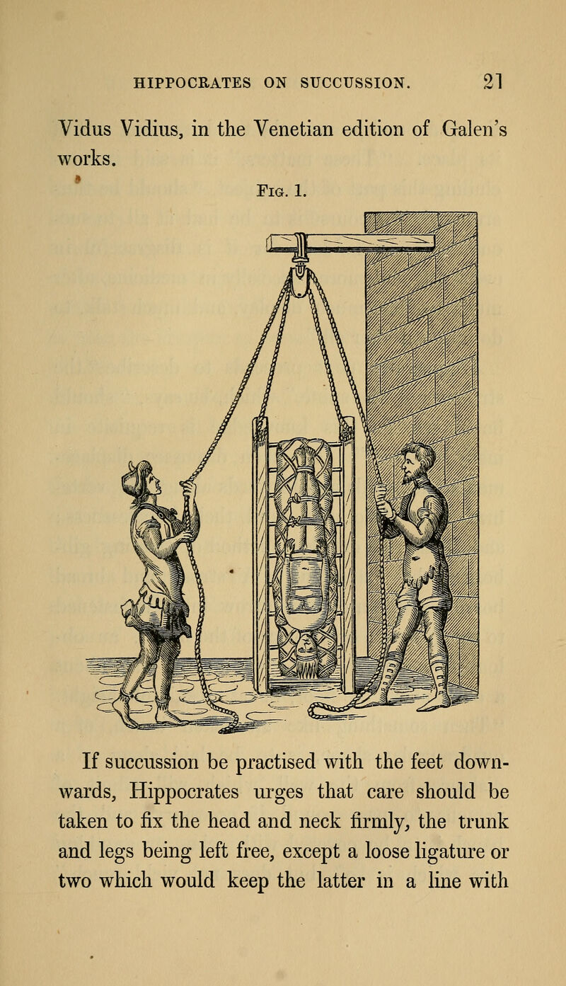 Vidus Vidiiis, in the Venetian edition of Galen's works. Fig. 1. If succussion be practised with the feet down- wards, Hippocrates urges that care should be taken to fix the head and neck firmly^ the trunk and legs being left free, except a loose Hgature or two which would keep the latter in a line with