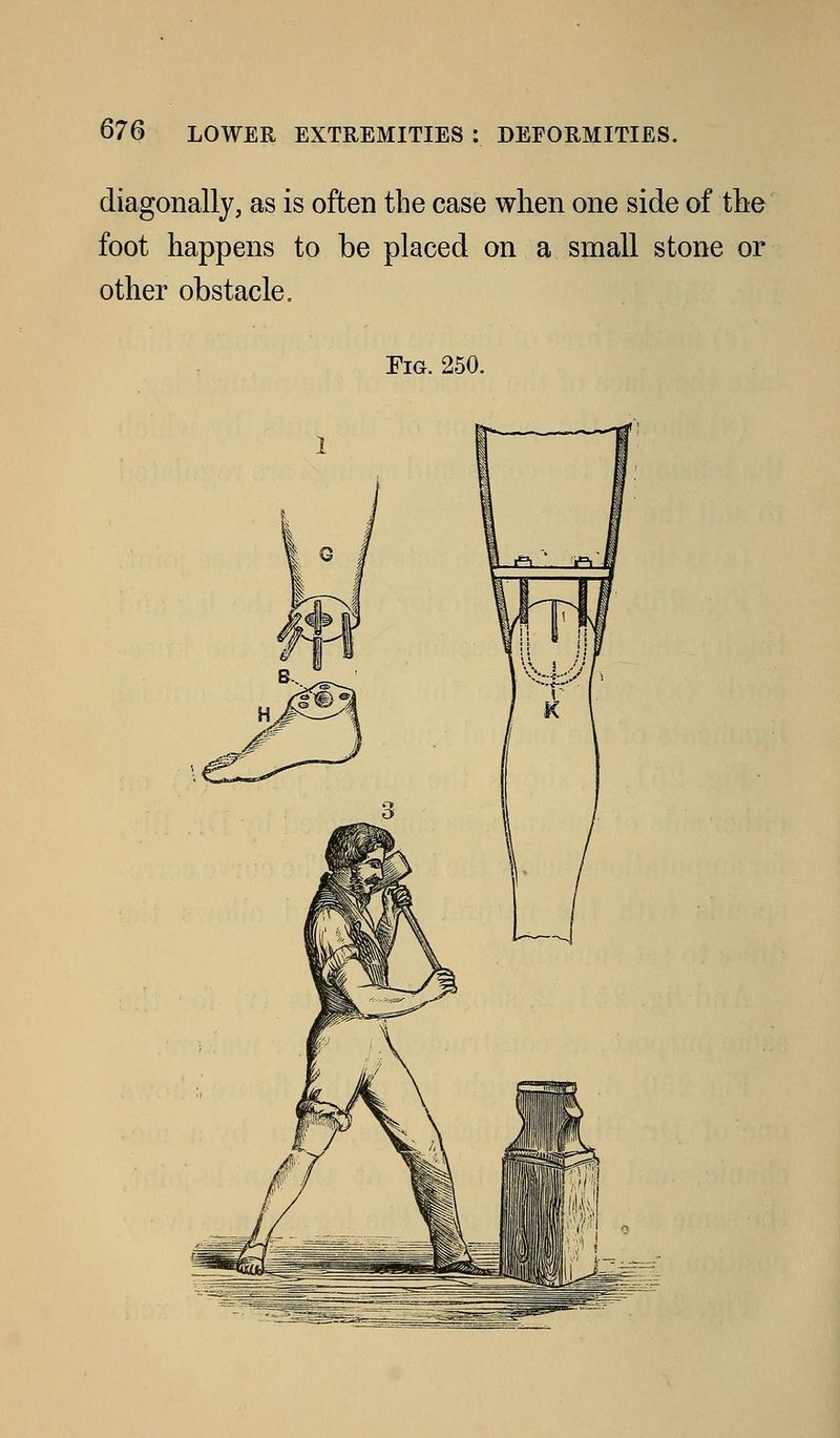 diagonally, as is often tbe case when one side of the foot happens to be placed on a small stone or other obstacle.