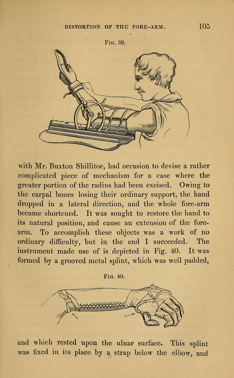 Fig. 39. with Mr. Buxton Shillitoe, had occasion to devise a rather complicated piece of mechanism for a case where the greater portion of the radius had been excised. Owing to the carpal bones losing their ordinary support, the hand dropped in a lateral direction_, and the whole fore-arm became shortened. It was sought to restore the hand to its natural position, and cause an extension of the fore- arm. To accomplish these objects was a work of no ordinary difficulty, but in the end I succeeded. The instrument made use of is depicted in Kg. 40. It was formed by a grooved metal splint, which was well padded, Tm. 40. and which rested upon the ulnar surface. This splint was fixed in its place by a strap below the elbow, and