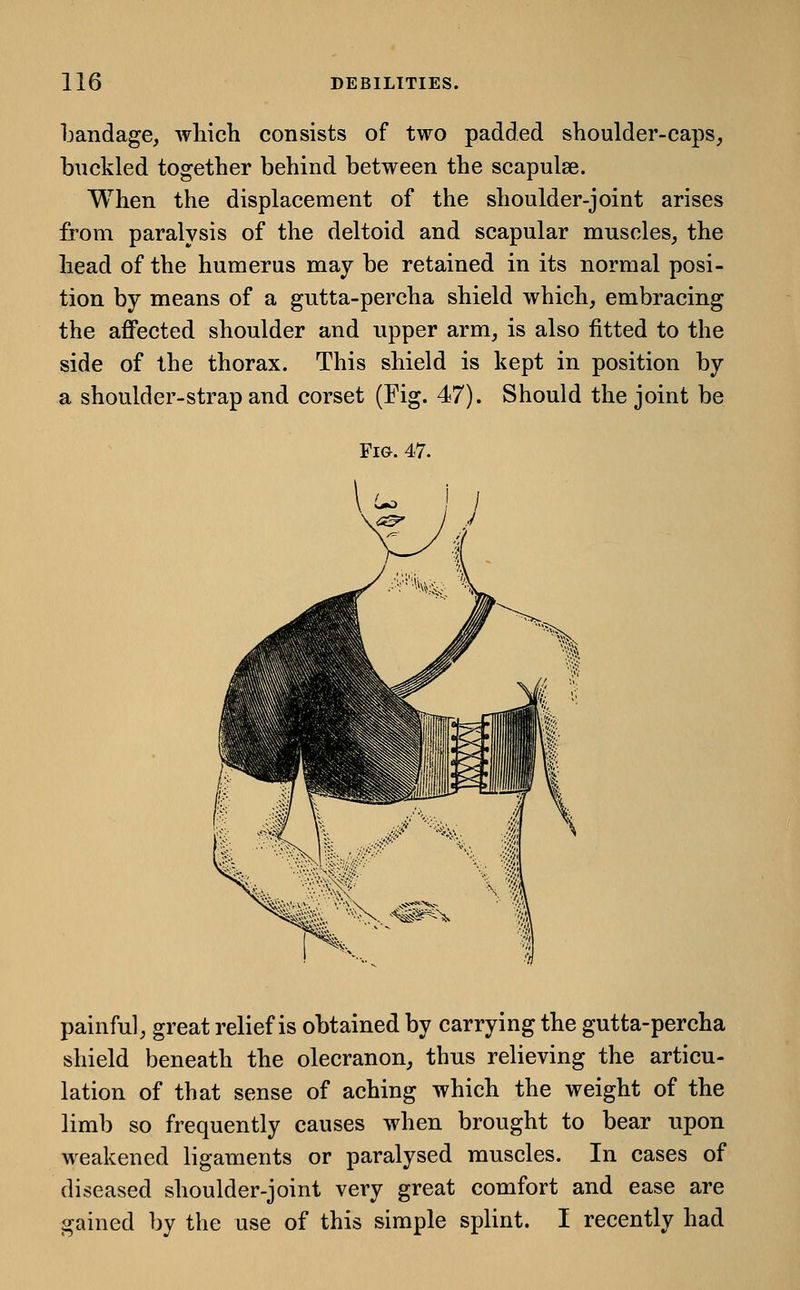 bandage, which consists of two padded shoulder-caps, buckled together behind between the scapulse. When the displacement of the shoulder-joint arises from paralysis of the deltoid and scapular muscles, the head of the humerus may be retained in its normal posi- tion by means of a gutta-percha shield which, embracing the affected shoulder and upper arm, is also fitted to the side of the thorax. This shield is kept in position by a shoulder-strap and corset (Fig. 47). Should the joint be Fig. 47. painful, great relief is obtained by carrying the gutta-percha shield beneath the olecranon, thus relieving the articu- lation of that sense of aching which the weight of the limb so frequently causes when brought to bear upon weakened ligaments or paralysed muscles. In cases of diseased shoulder-joint very great comfort and ease are gained by the use of this simple splint. I recently had