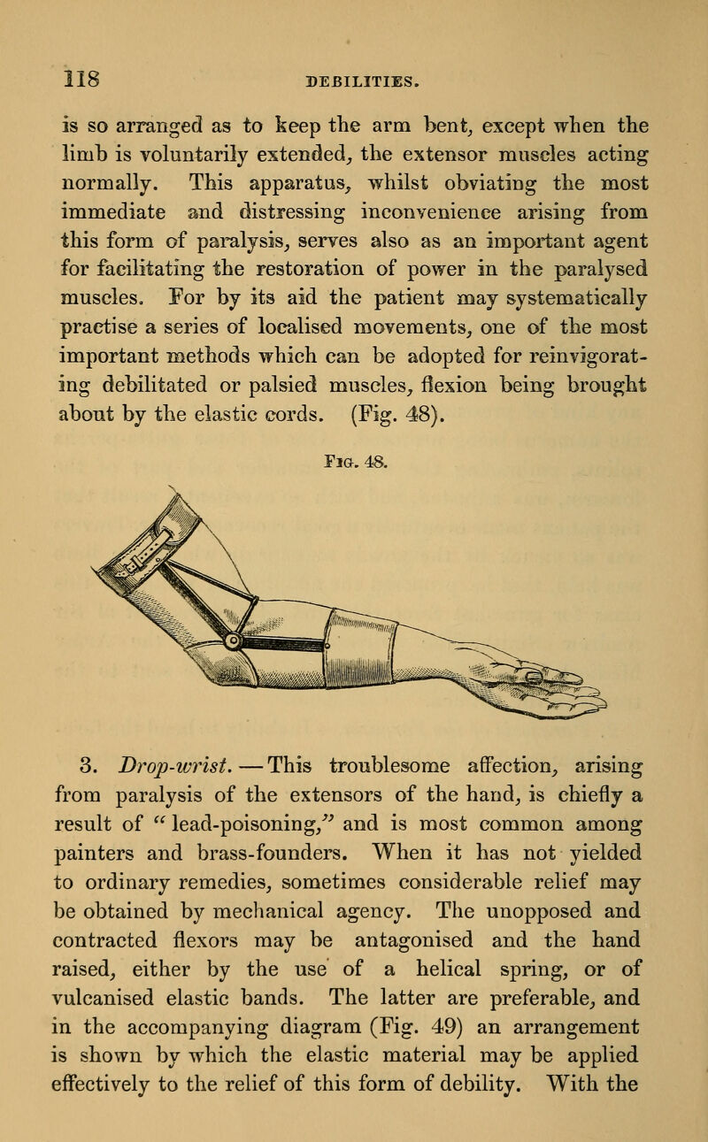 is SO arranged as to keep the arm bent^ except when the limb is voluntarily extended,, the extensor muscles acting normally. This apparatus, whilst obviating the most immediate and distressing inconvenience arising from this form of paralysis, serves also as an important agent for facilitating the restoration of power in the paralysed muscles, For by its aid the patient may systematically practise a series of localised movements, one of the most important methods which can be adopted for reinvigorat- ing debilitated or palsied muscles, flexion being brought about by the elastic cords. (Fig. 48). Fia. 48. 3. Drop-wrist.—This troublesome affection, arising from paralysis of the extensors of the hand, is chiefly a result of  lead-poisoning,^^ and is most common among painters and brass-founders. When it has not yielded to ordinary remedies, sometimes considerable relief may be obtained by mechanical agency. The unopposed and contracted flexors may be antagonised and the hand raised, either by the use of a helical spring, or of vulcanised elastic bands. The latter are preferable, and in the accompanying diagram (Fig. 49) an arrangement is shown by which the elastic material may be applied effectively to the relief of this form of debility. With the