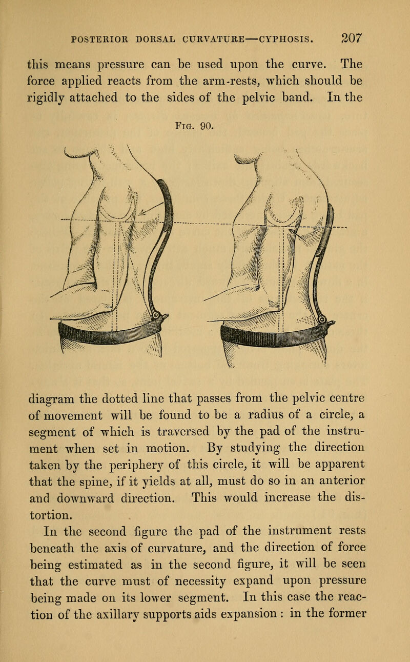 this means pressure can be used upon the curve. The force applied reacts from the arm-rests, which should be rigidly attached to the sides of the pelvic band. In the Fig. 90. diagram the dotted line that passes from the pelvic centre of movement will be found to be a radius of a circle, a segment of which is traversed by the pad of the instru- ment when set in motion. By studying the direction taken by the periphery of this circle, it will be apparent that the spine, if it yields at all, must do so in an anterior and downward direction. This would increase the dis- tortion. In the second figure the pad of the instrument rests beneath the axis of curvature, and the direction of force being estimated as in the second figure, it will be seen that the curve must of necessity expand upon pressure being made on its lower segment. In this case the reac- tion of the axillary supports aids expansion : in the former