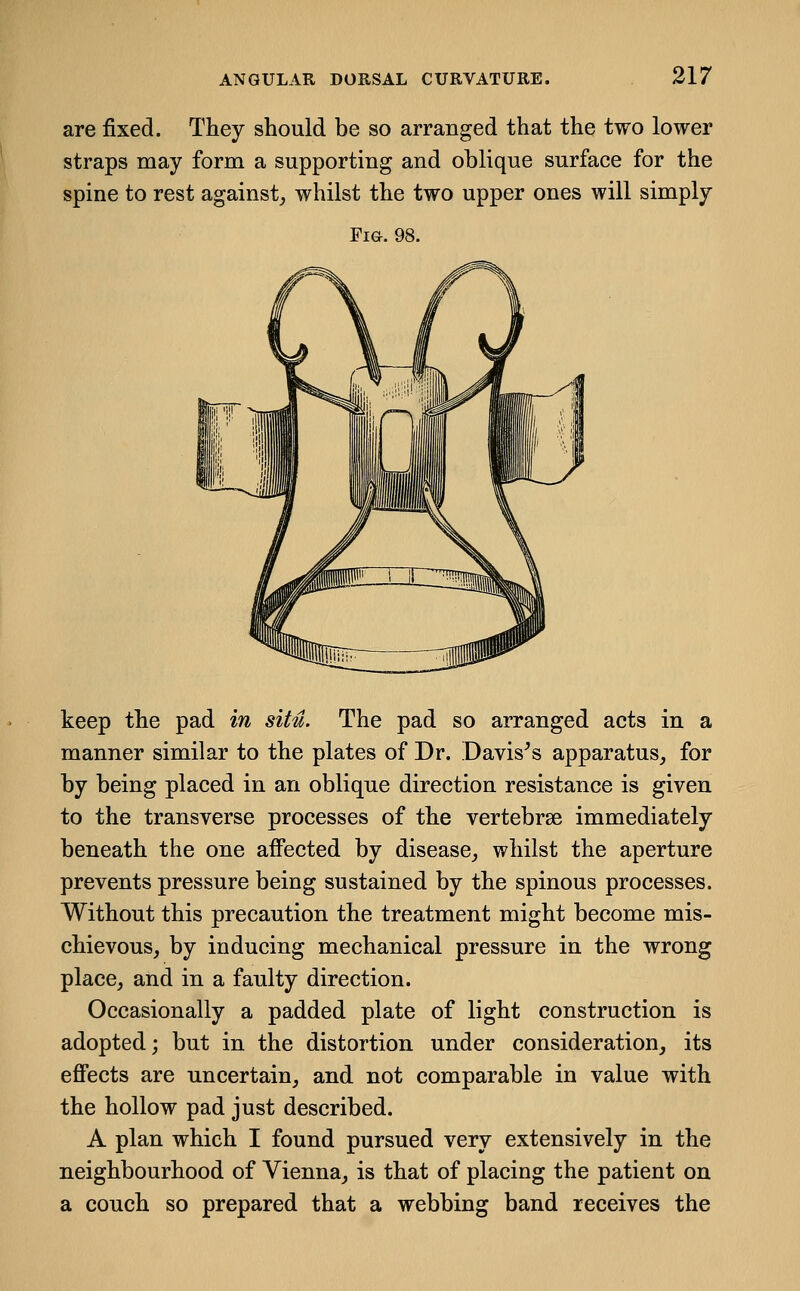 are fixed. They should be so arranged that the two lower straps may form a supporting and oblique surface for the spine to rest against^ whilst the two upper ones will simply Fig. 98. keep the pad in situ. The pad so arranged acts in a manner similar to the plates of Dr. Davis^s apparatus, for by being placed in an oblique direction resistance is given to the transverse processes of the vertebrae immediately beneath the one affected by disease, whilst the aperture prevents pressure being sustained by the spinous processes. Without this precaution the treatment might become mis- chievous, by inducing mechanical pressure in the wrong place, and in a faulty direction. Occasionally a padded plate of light construction is adopted; but in the distortion under consideration, its effects are uncertain, and not comparable in value with the hollow pad just described. A plan which I found pursued very extensively in the neighbourhood of Vienna, is that of placing the patient on a couch so prepared that a webbing band receives the