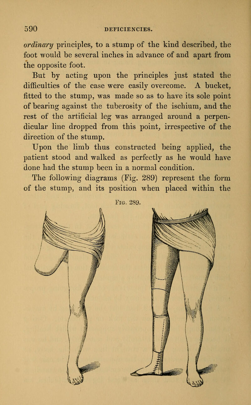 ordinary principles, to a stump of the kind described, the foot would be several inches in advance of and apart from the opposite foot. But by acting upon the principles just stated the difficulties of the case were easily overcome. A bucket, fitted to the stump, was made so as to have its sole point of bearing against the tuberosity of the ischium, and the rest of the artificial leg was arranged around a perpen- dicular line dropped from this point, irrespective of the direction of the stump. Upon the limb thus constructed being applied, the patient stood and walked as perfectly as he would have done had the stump been in a normal condition. The following diagrams (Fig. 289) represent the form of the stump, and its position when placed within the