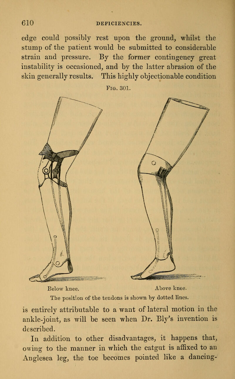 edge could possibly rest upon the ground_, whilst the stump of the patient would be submitted to considerable strain and pressure. By the former contingency great instability is occasioned^ and by the latter abrasion of the skin generally results. This highly objectionable condition Fig-. 301. Below knee. Above knee. The position of the tendons is shown by dotted lines. is entirely attributable to a want of lateral motion in the ankle-joint, as will be seen when Dr. Ely's invention is described. In addition to other disadvantages, it happens that, owing to the manner in which the catgut is affixed to an Anglesea leg, the toe becomes pointed like a dancing-