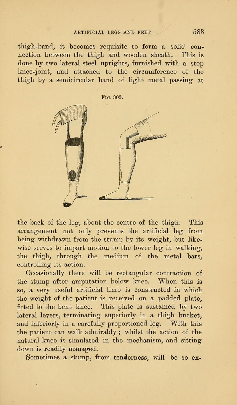 thigh-band, it becomes requisite to form a solid con- nection between the thigh and wooden sheath. This is done by two lateral steel uprights, furnished with a stop knee-joint, and attached to the circumference of the thigh by a semicircular band of light metal passing at Fig. 303. the back of the leg, about the centre of the thigh. This arrangement not only prevents the artificial leg from being withdrawn from the stump by its weight, but like- wise serves to impart motion to the lower leg in walking, the thigh, through the medium of the metal bars, controlling its action. Occasionally there will be rectangular contraction of the stump after amputation below knee. When this is so, a very useful artificial limb is constructed in which the weight of the patient is received on a padded plate, fitted to the bent knee. This plate is sustained by two lateral levers, terminating superiorly in a thigh bucket, and inferiorly in a carefully proportioned leg. With this the patient can walk admirably ; whilst the action of the natural knee is simulated in the mechanism, and sitting down is readily managed. Sometimes a stump, from tenderness, will be so ex-