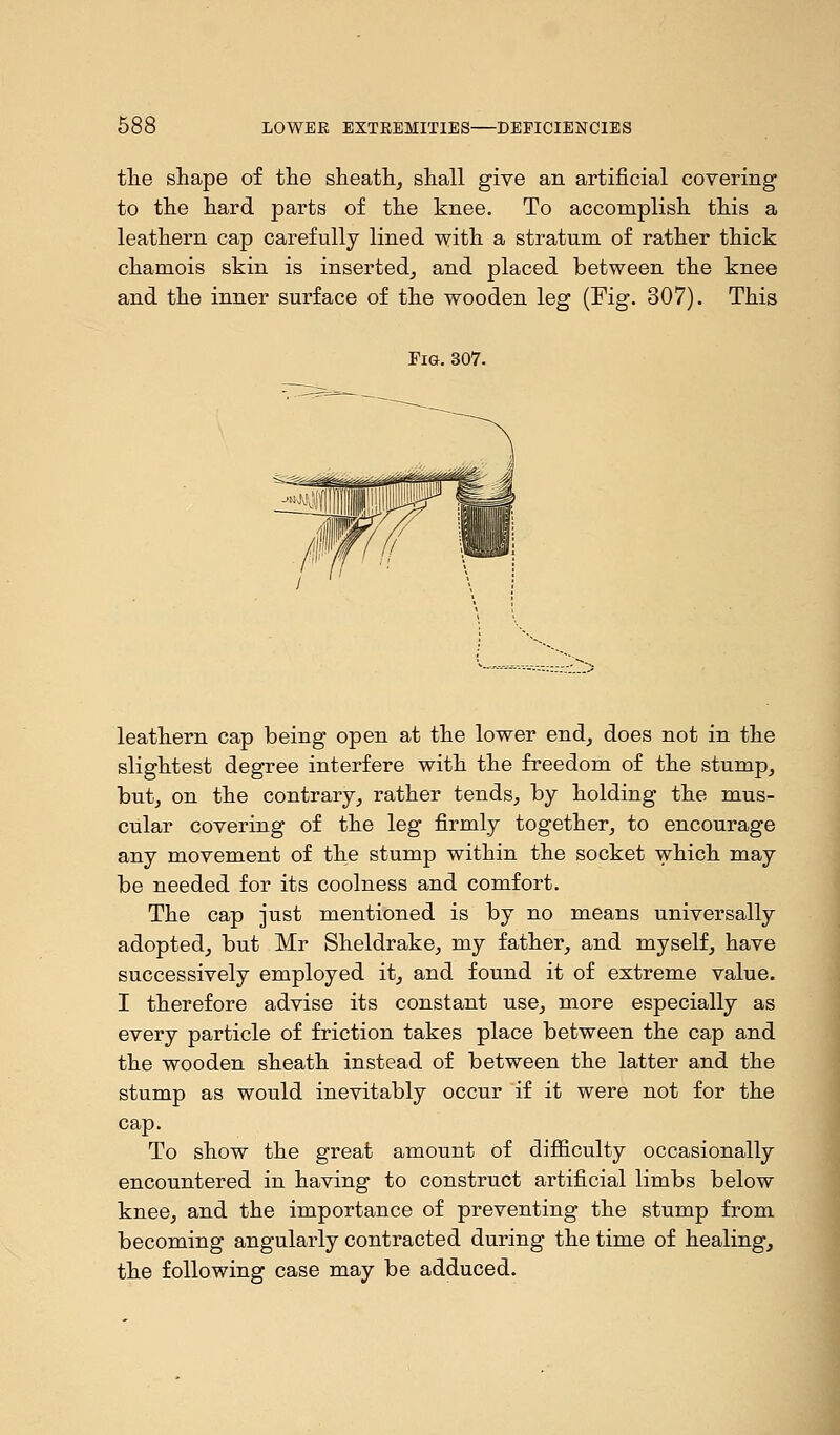 the shape of the sheath, shall give an artificial covering to the hard parts of the knee. To accomplish this a leathern cap carefully lined with a stratum of rather thick chamois skin is inserted, and placed between the knee and the inner surface of the wooden leg (Fig. 307). This Fig. 307. leathern cap being open at the lower end, does not in the slightest degree interfere with the freedom of the stump, but, on the contrary, rather tends, by holding the mus- cular covering of the leg firmly together, to encourage any movement of the stump within the socket which may be needed for its coolness and comfort. The cap just mentioned is by no means universally adopted, but Mr Sheldrake, my father, and myself, have successively employed it, and found it of extreme value. I therefore advise its constant use, more especially as every particle of friction takes place between the cap and the wooden sheath instead of between the latter and the stump as would inevitably occur if it were not for the cap. To show the great amount of difficulty occasionally encountered in having to construct artificial limbs below knee, and the importance of preventing the stump from becoming angularly contracted during the time of healing, the following case may be adduced.