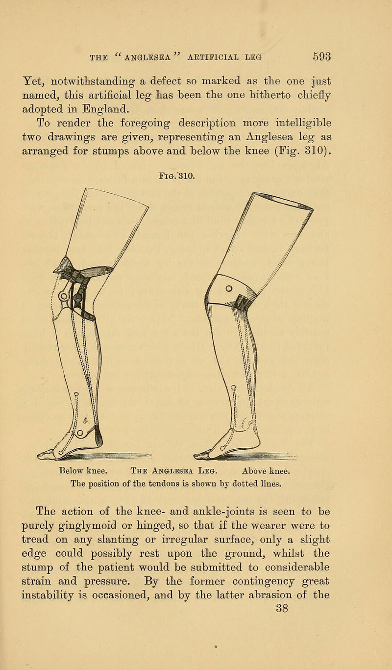 Yet, notwithstanding a defect so marked as the one just named, this artificial leg has been the one hitherto chiefly adopted in England. To render the foregoing description more intelligible two drawings are given, representing an Anglesea leg as arranged for stumps above and below the knee (Fig. 310). Fig. 310. Below knee. The Angeesea Leg. Above knee. The position of the tendons is shown by dotted lines. The action of the knee- and ankle-joints is seen to be purely ginglymoid or hinged, so that if the wearer were to tread on any slanting or irregular surface, only a slight edge could possibly rest upon the ground, whilst the stump of the patient would be submitted to considerable strain and pressure. By the former contingency great instability is occasioned, and by the latter abrasion of the 38