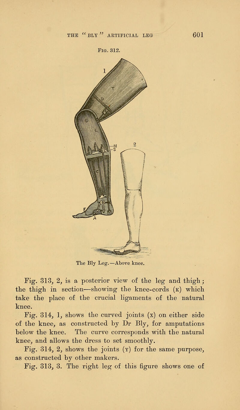 CC ■r.-r^r >> THE BLY ARTIFICIAL LEG Fig. 312. 601 The Bly Leg.—Above knee. Fig. 313, 2, is a posterior view of the leg and thigh; the thigh in section—showing the knee-cords (k) which take the place of the crucial ligaments of the natural knee. Fig. 314, 1, shows the curved joints (x) on either side of the knee, as constructed by Dr Bly, for amputations below the knee. The curve corresponds with the natural knee, and allows the dress to set smoothly. Fig. 314, 2, shows the joints (y) for the same purpose, as constructed by other makers. Fig. 313, 3. The right leg of this figure shows one of
