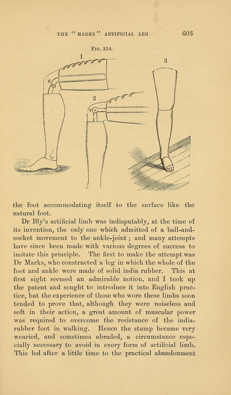 Fig. 314. the foot accommodating itself to the surface like the natural foot. Dr Bly's artificial limb was indisputably, at the time of its invention, the only one which admitted of a ball-and- socket movement to the ankle-joint; and many attempts have since been made with various degrees of success to imitate this principle. The first to make the attempt was Dr Marks, who constructed a leg in which the whole of the foot and ankle were made of solid india rubber. This at first sight seemed an admirable notion, and I took up the patent and sought to introduce it into English prac- tice, but the experience of those who wore these limbs soon tended to prove that, although they were noiseless and soft in their action, a great amount of muscular power was required to overcome the resistance of the india- rubber foot in walking. Hence the stump became very wearied, and sometimes abraded, a circumstance espe- cially necessary to avoid in every form of artificial limb. This led after a little time to the practical abandonment