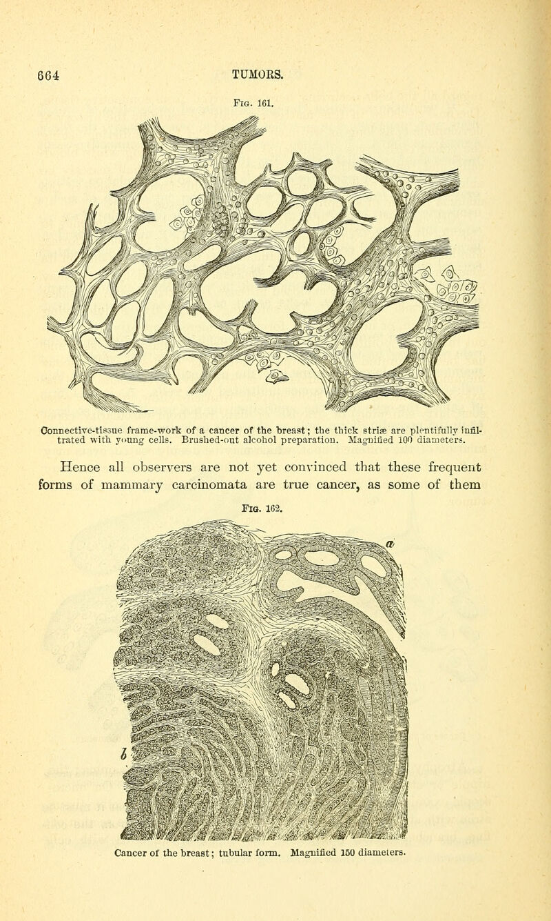 Connective-tissue frame-work of a cancer of the breast; the thick strise are plentifully infil- trated with young cells. Brushed-out alcohol preparation. Magnified 100 diameters. Hence all observers are not yet convinced that these frequent forms of mammary carcinomata are true cancer, as some of them Fig. 162. Cancer of the breast; tubular form. Magnified 150 diameters.