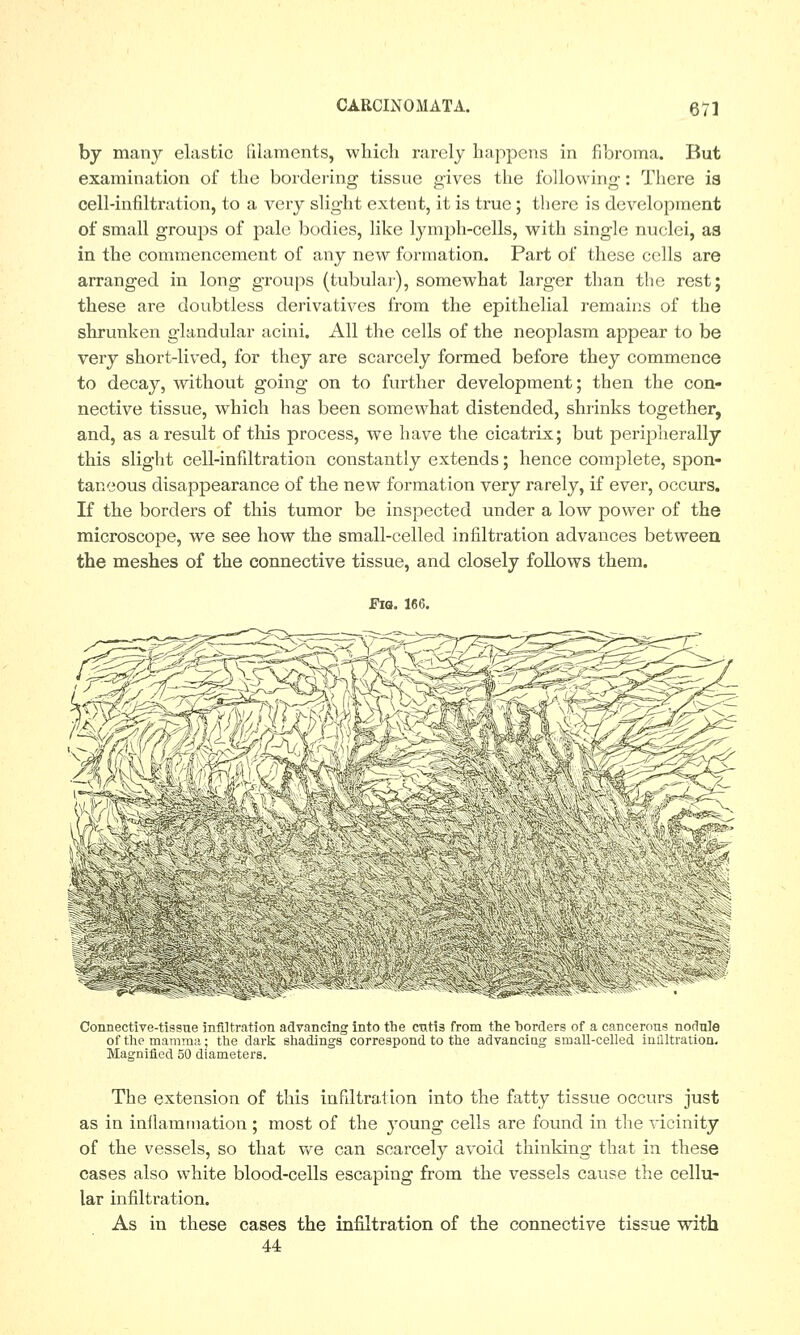 by many elastic filaments, which rarely happens in fibroma. But examination of the bordering tissue gives the following: There is cell-infiltration, to a very slight extent, it is true; there is development of small groups of pale bodies, like lymph-cells, with single nuclei, as in the commencement of any new formation. Part of these cells are arranged in long groups (tubular), somewhat larger than the rest; these are doubtless derivatives from the epithelial remains of the shrunken glandular acini. All the cells of the neoplasm appear to be very short-lived, for they are scarcely formed before they commence to decay, without going on to further development; then the con- nective tissue, which has been somewhat distended, shrinks together, and, as a result of this process, we have the cicatrix; but peripherally this slight cell-infiltration constantly extends; hence complete, spon- taneous disappearance of the new formation very rarely, if ever, occurs. If the borders of this tumor be inspected under a low power of the microscope, we see how the small-celled infiltration advances between the meshes of the connective tissue, and closely follows them. Fia. 166. Connective-tissue infiltration advancing into the cutis from the borders of a cancerous nodule of the mamma; the dark shadings correspond to the advanciug small-celled infiltration. Magnified 50 diameters. The extension of this infiltration into the fatty tissue occurs just as in inflammation ; most of the young cells are found in the vicinity of the vessels, so that we can scarcely avoid thinking that in these cases also white blood-cells escaping from the vessels cause the cellu- lar infiltration. As in these cases the infiltration of the connective tissue with 44