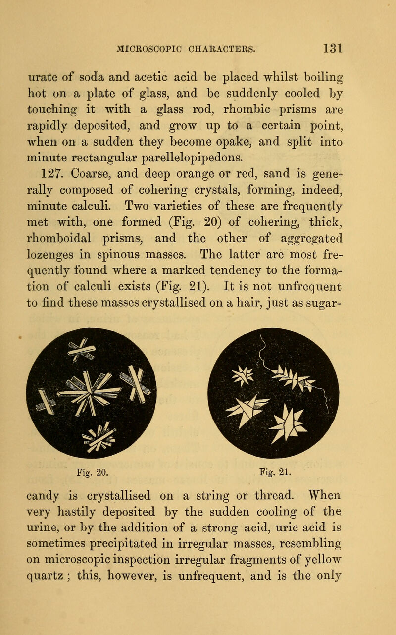 urate of soda and acetic acid be placed whilst boiling hot on a plate of glass, and be suddenly cooled by touching it with a glass rod, rhombic prisms are rapidly deposited, and grow up to a certain point, when on a sudden they become opake, and split into minute rectangular parellelopipedons. 127. Coarse, and deep orange or red, sand is gene- rally composed of cohering crystals, forming, indeed, minute calculi. Two varieties of these are frequently met with, one formed (Fig. 20) of cohering, thick, rhomboidal prisms, and the other of aggregated lozenges in spinous masses. The latter are most fre- quently found where a marked tendency to the forma- tion of calculi exists (Fig. 21). It is not unfrequent to find these masses crystallised on a hair, just as sugar- & i .■#£* Fig. 20. Fig. 21. candy is crystallised on a string or thread. When very hastily deposited by the sudden cooling of the urine, or by the addition of a strong acid, uric acid is sometimes precipitated in irregular masses, resembling on microscopic inspection irregular fragments of yellow quartz ; this, however, is unfrequent, and is the only