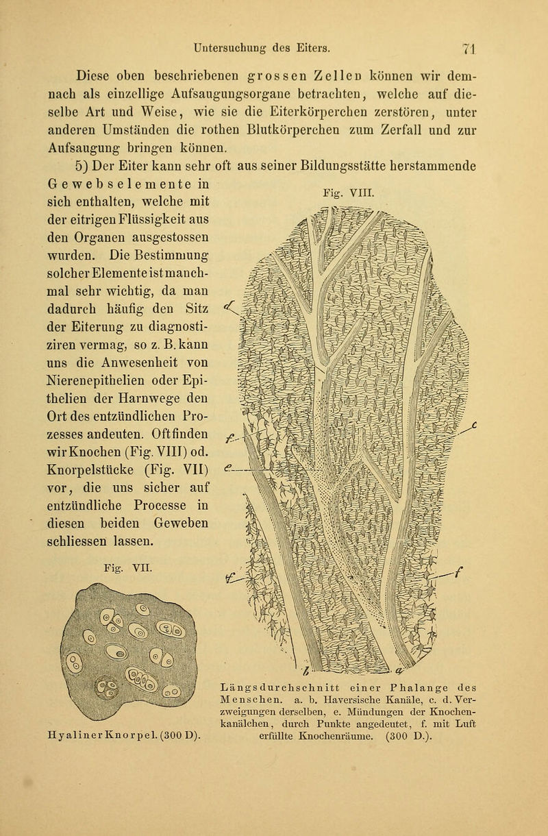 Diese oben beschriebenen grossen Zellen können wir dem- nach als einzellige Aufsaugungsorgane betrachten, welche auf die- selbe Art und Weise, wie sie die Eiterkörperchen zerstören, unter anderen Umständen die rothen Blutkörperchen zum Zerfall und zur Aufsaugung bringen können. 5) Der Eiter kann sehr oft aus seiner Bildungsstätte herstammende Gewebselemente in sich enthalten, welche mit der eitrigen Flüssigkeit aus den Organen ausgestossen wurden. Die Bestimmung solcher Elemente ist manch- mal sehr wichtig, da man dadurch häufig den Sitz der Eiterung zu diagnosti- ziren vermag, so z. B.kann uns die Anwesenheit von Nierenepithelien oder Epi- thelien der Harnwege den Ort des entzündlichen Pro- zesses andeuten. Oftfinden wir Knochen (Fig. VIII) od. KnorpelstUcke (Fig. VII) vor, die uns sicher auf entzündliche Processe in diesen beiden Geweben schliessen lassen. H y aliner Knorpel. (300 D). Längs durchschnitt einer Phalange des Menschen, a. b. Haversische Kanäle, c. d.Ver- zweigungen derselben, e. Mündungen der Knochen- kanälchen, durch Punkte angedeutet, f. mit Luft erfüllte Knochenräume. (300 D.).