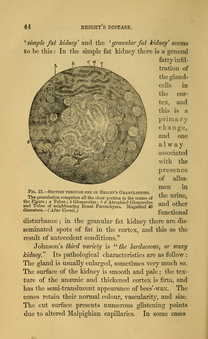 'simple fat kidney'' and the cgranular fat kidneif seems to be this : In the simple fat kidney there is a general fatty infil- c a tration of the gland- cells in the cor- tex, and this is a primary change, and one alway associated with the presence of albu- men in Fig. 12.—Section through one of Bkight's Granulations. ,-i The granulation comprises all the clear portion in the centre of *^e UTlIie, the Figure ; a Tubes • b Glomerulus ; h d Atrophied Glomerulus o-p^ nfkPT, and Tubes of neighbouring Kenal Parenchyma. Magnified 40 cU1U ulLLCi diameters.-f^r Cornil.J functional disturbance ; in the granular fat kidney there are dis- seminated spots of fat in the cortex, and this as the result of antecedent conditions. Johnson's third variety is  the lardaceous, or tuaxy kidney. Its pathological characteristics are as follow : The gland is usually enlarged, sometimes very much so. The surface of the kidney is smooth and pale; the tex- ture of the anaemic and thickened cortex is firm, and has the semi-translucent appearance of bees'-wax. The cones retain their normal colour, vascularity, and size. The cut surface presents numerous glistening points due to altered Malpighian capillaries. In some cases