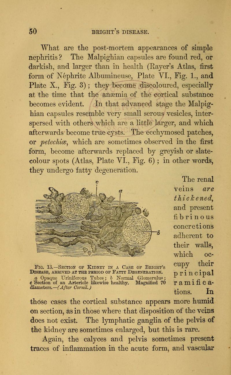 What are the post-mortem appearances of simple nephritis ? The Malpighian capsules are found red, or darkish, and larger than in health (Rayer's Atlas, first form of Nephrite Albumineuse, Plate VI., Fig. 1., and Plate X., Fig. 3) ; they become discoloured, especially at the time that the anaemia of the cortical substance becomes evident. In that advanced stage the Malpig- hian capsules resemble very small serous vesicles, inter- spersed with others which are a little larger, and which afterwards become true cysts. The ecchymosed patches, or petechice, which are sometimes observed in the first form, become afterwards replaced by greyish or slate- colour spots (Atlas, Plate VI., Fig. 6); in other words, they undergo fatty degeneration. The renal veins are thickened, and present fibrinous concretions adherent to their walls, which oc- cupy their p rincipal ramifica- tions. In those cases the cortical substance appears more humid on section, as in those where that disposition of the veins does not exist. The lymphatic ganglia of the pelvis of the kidney are sometimes enlarged, but this is rare. Again, the calyces and pelvis sometimes present traces of inflammation in the acute form, and vascular Fig. 13.—Section op Kidney in a Case of Briget's Disease, arrived at the period op Fatty Degeneration. a Opaque Uriniferous Tubes; b Normal Glomerulus; c Section of an Arteriole likewise healthy. Magnified 70 diameters.—(After Cornil.)