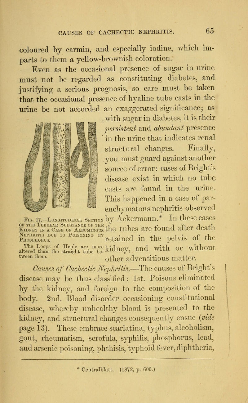 CAUSES OF CACHECTIC NEPHRITIS. coloured by carmin, and especially iodine, which im- parts to them a yellow-brownish coloration. Even as the occasional presence of sugar in urine must not be regarded as constituting diabetes, and justifying a serious prognosis, so care must be taken that the occasional presence of hyaline tube casts in the urine be not accorded an exaggerated significance; as with sugar in diabetes, it is their persistent and abundant presence  in the urine that indicates renal structural changes. Finally, you must guard against another source of error: cases of Bright's disease exist in which no tube casts are found in the urine. This happened in a case of par- enchymatous nephritis observed Fig. 17.-Longitudinal Section by Ackermann.* Ill these Cases of the Tubular Substance of the , 1 . n r ~\ £■+„■„ J«„+L Kidney in a Case of Albuminous the tubes are found alter CLeatn Nephritis due to Poisoning by . . t . ,-t i • „n +t_ . Phosphorus. retained m the pelvis ot tne The Loops of Henle are more -y'rlinOT7 0-^] wifL OT» without altered than the straight tube be-KlClliey? anCl WltU 0i WiLiiUUL tween them. ot}ier adventitious matter. Causes of Cachectic Nephritis.—The causes of Bright's disease may be thus classified: 1st. Poisons eliminated by the kidney, and foreign to the composition of the body. 2nd. Blood disorder occasioning constitutional disease, whereby unhealthy blood is presented to the kidney, and structural changes consequently ensue (vide page 13). These embrace scarlatina, typhus, alcoholism, gout, rheumatism, scrofula, syphilis, phosphorus, lead, and arsenic poisoning, phthisis, typhoid fever, diphtheria, Ccntralblatt. (1872, p. 606.)