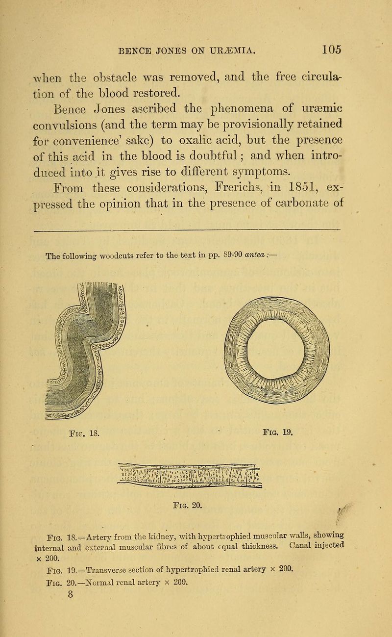 when the obstacle was removed, and the free circula- tion of the blood restored. Bence Jones ascribed the phenomena of ursemic convulsions (and the term may be provisionally retained for convenience' sake) to oxalic acid, but the presence of this acid in the blood is doubtful; and when intro- duced into it gives rise to different symptoms. From these considerations, Frerichs, in 1851, ex- pressed the opinion that in the presence of carbonate of The following woodcuts refer to the text in pp. S9-90 antea, Fie. 18. Fig. 19. mjj-v- l_ wj^jj-u^^Jn • Fig. 20. ■pia. 18.--Artery from the kidney, with hypartiophied muscular walls, showing internal and external muscular fibres of about equal thickness. Canal injected x 200. Fig. 19.—Transverse section of hypertrophied renal artery x 200. Fig. 20.—Normal renal artery x 200. 8