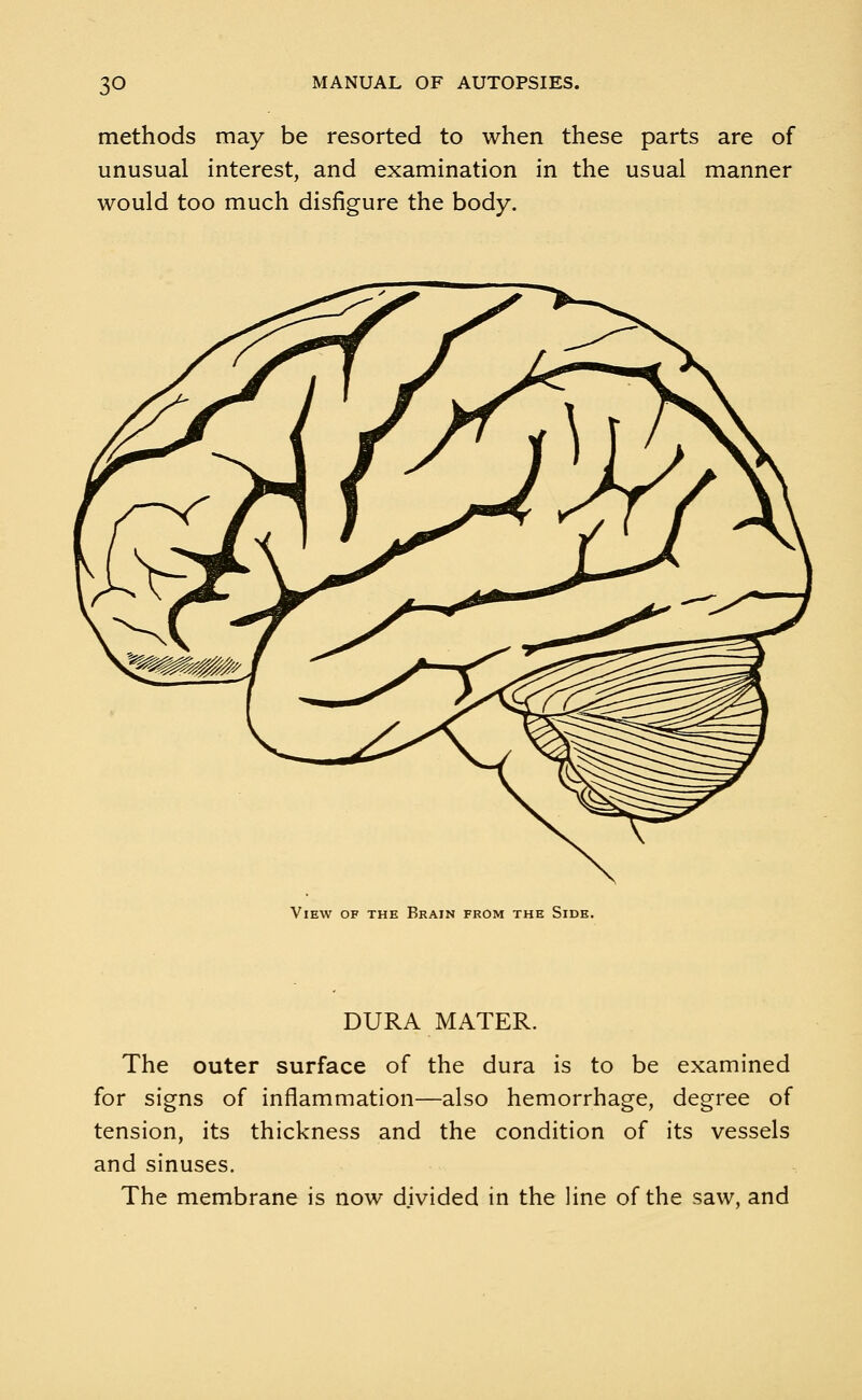 methods may be resorted to when these parts are of unusual interest, and examination in the usual manner would too much disfigure the body. View of the Brain from the Side. DURA MATER. The outer surface of the dura is to be examined for signs of inflammation—also hemorrhage, degree of tension, its thickness and the condition of its vessels and sinuses. The membrane is now divided in the line of the saw, and