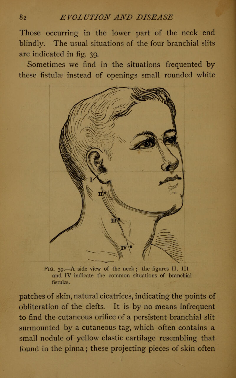 Those occurring in the lower part of the neck end blindly. The usual situations of the four branchial slits are indicated in fig. 39. Sometimes we find in the situations frequented by these fistulae instead of openings small rounded white Fig. 39.—A side view of the neck; the figures II, III and IV indicate the common situations of branchial fistuloe. patches of skin, natural cicatrices, indicating the points of obliteration of the clefts. It is by no means infrequent to find the cutaneous orifice of a persistent branchial slit surmounted by a cutaneous tag, which often contains a small nodule of yellow elastic cartilage resembling that found in the pinna; these projecting pieces of skin often