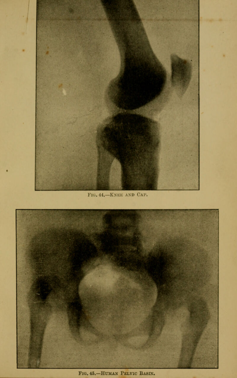 riG. 44.—Knkk and Cat Fig. 45.—Humax Pjklvic Basin.