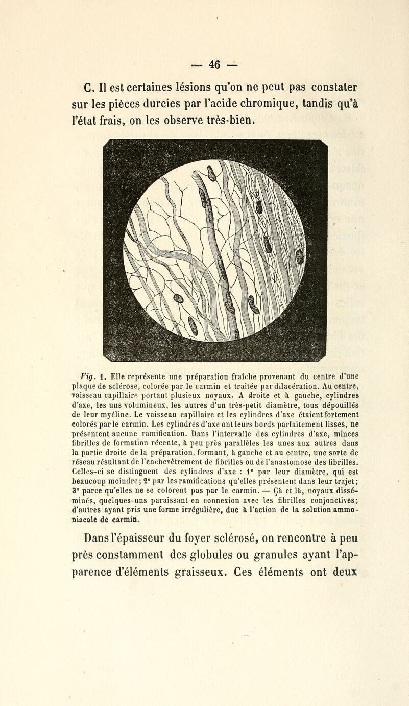 C. Il est certaines lésions qu'on ne peut pas constater sur les pièces durcies par l'acide chromique, tandis qu'à l'état frais, on les observe très-bien. Fig. i. Elle représente une préparation fraîche provenant du centre d'une plaque de sclérose, colorée par le carmin et traitée par dilacération. Au centre, vaisseau capillaire portant plusieux noyaux. A droite et a gauche, cylindres d'axe, les uns volumineux, les autres d'un très-petit diamètre, tous dépouillés de leur myéline. Le vaisseau capillaire et les cylindres d'axe étaient fortement colorés par le carmin. Les cylindres d'axe ont leurs bords parfaitement lisses, ne présentent aucune ramification. Dans l'intervalle des cylindres d'axe, minces fibrilles de formation récente, à peu près parallèles les unes aux autres dans la partie droite de la préparation, formant, à gauche et au centre, une sorte de réseau résultant de l'enchevêtrement de fibrilles ou de l'anastomose des fibrilles. Celles-ci se distinguent des cylindres d'axe : 1 par leur diamètre, qui est beaucoup moindre; 2° par les ramifications qu'elles présentent dans leur trajet; 3° parce qu'elles ne se colorent pas par le carmin. — Ça et là, noyaux dissé- minés, queiques-uns paraissant en connexion avec les fibrilles conjonctives; d'autres ayant pris une forme irrégulière, due à l'action de la solution ammo- niacale de carmin. Dans l'épaisseur du foyer sclérosé, on rencontre à peu près constamment des globules ou granules ayant l'ap- parence d'éléments graisseux. Ces éléments ont deux