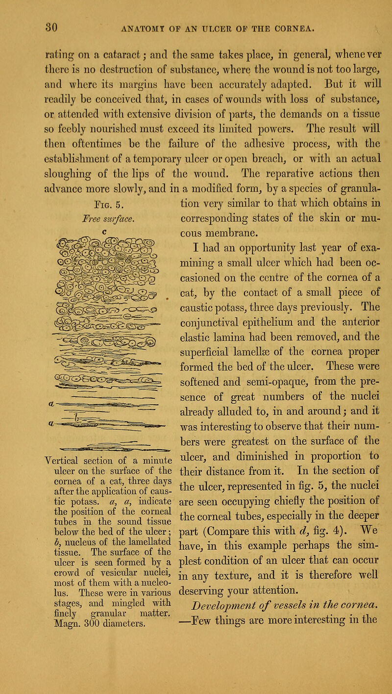 Tig. 5. Tree surface. rating on a cataract; and the same takes place, in general, whenever there is no destruction of substance, where the wound is not too large, and where its margins have been accurately adapted. But it will readily be conceived that, in cases of wounds with loss of substance, or attended with extensive division of parts, the demands on a tissue so feebly nourished must exceed its limited powers. The result will then oftentimes be the failure of the adhesive process, with the establishment of a temporary ulcer or open breach, or with an actual sloughing of the lips of the wound. The reparative actions then advance more slowly, and in a modified form, by a species of granula- tion very similar to that which obtains in corresponding states of the skin or mu- cous membrane. I had an opportunity last year of exa- mining a small ulcer which had been oc- casioned on the centre of the cornea of a cat, by the contact of a small piece of caustic potass, three days previously. The conjunctival epithelium and the anterior elastic lamina had been removed, and the superficial laniellse of the cornea proper formed the bed of the ulcer. These were softened and semi-opaque, from the pre- sence of great numbers of the nuclei already alluded to, in and around; and it was interesting to observe that their num- bers were greatest on the surface of the Vertical section of a minute ^cer, and diminished in proportion to ulcer on the surface of the their distance from it. In the section of SThelpplSionof cS *• deer,represented in fig. 5, the nuclei tic potass, a, a, indicate are seen occupying chiefly the position of SZW.SrftSSi the «™! tubes, especially in the deeper below the bed of the ulcer; part (Compare this with d, fig. 4). We b nucleus of the lamented h in this example perhaps the sim- ulcer is seen formed by a plest condition of an ulcer that can occur crowd of vesicular nuclei, in texture, and it is therefore well most of them with a nucieo- J. lus. These were in various deserving your attention. stages, and mingled with Development of vessels in the cornea. finely granular matter. _ „, . , ,. . ,, Magn. 300 diameters. —Few things are more interesting m the