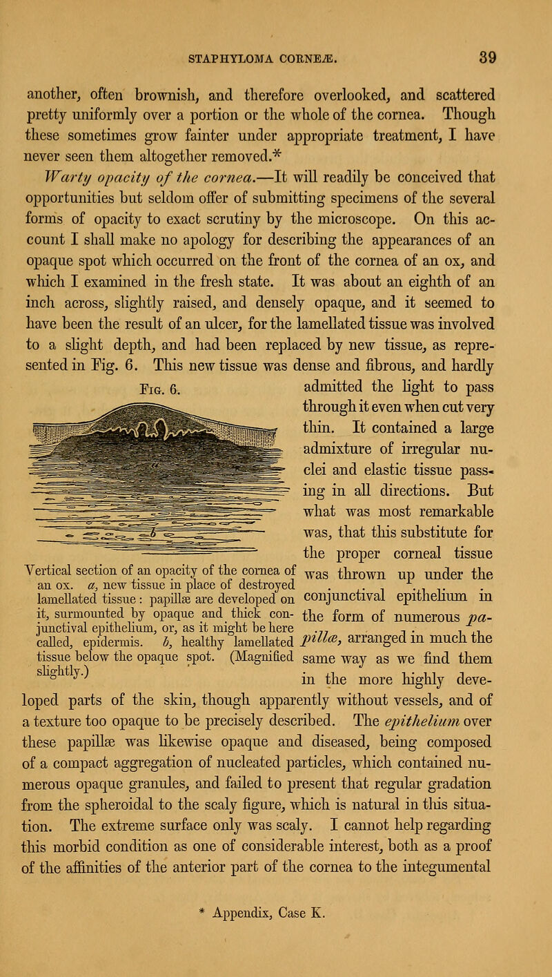 another, often brownish, and therefore overlooked, and scattered pretty uniformly over a portion or the whole of the cornea. Though these sometimes grow fainter under appropriate treatment, I have never seen them altogether removed.* Warty opacity of the cornea.—It will readily be conceived that opportunities but seldom offer of submitting specimens of the several forms of opacity to exact scrutiny by the microscope. On this ac- count I shall make no apology for describing the appearances of an opaque spot which occurred on the front of the cornea of an ox, and which I examined in the fresh state. It was about an eighth of an inch across, slightly raised, and densely opaque, and it seemed to have been the result of an ulcer, for the lamellated tissue was involved to a slight depth, and had been replaced by new tissue, as repre- sented in Kg. 6. Tins new tissue was dense and fibrous, and hardly Fig. 6. admitted the light to pass through it even when cut very thin. It contained a large admixture of irregular nu- clei and elastic tissue pass- ing in all directions. But what was most remarkable was, that this substitute for the proper corneal tissue Vertical section of an opacity of the cornea of was thrown up under the an ox. a, new tissue in place of destroyed . lamellated tissue: papillee are developed on conjunctival epithelium m it, surmounted by opaque and thick con- the form of numerous pa- iunctival epithelium, or, as it might be here .77 , . , ,, called, epidermis, b, healthy lamellated PtU(B> arranged in much the tissue below the opaque spot. (Magnified same way as we find them ^ ^ in the more highly deve- loped parts of the skin, though apparently without vessels, and of a texture too opaque to be precisely described. The epithelium over these papillae was likewise opaque and diseased, being composed of a compact aggregation of nucleated particles, which contained nu- merous opaque granules, and failed to present that regular gradation from the spheroidal to the scaly figure, which is natural in this situa- tion. The extreme surface only was scaly. I cannot help regarding this morbid condition as one of considerable interest, both as a proof of the affinities of the anterior part of the cornea to the integumental