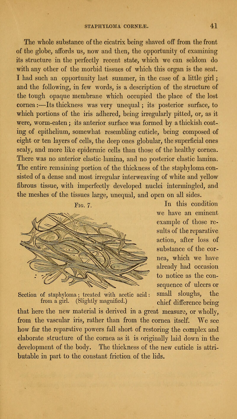 The whole substance of the cicatrix being shaved off from the front of the globe, affords us, now and then, the opportunity of examining its structure in the perfectly recent state, which we can seldom do with any other of the morbid tissues of which this organ is the seat. I had such an opportunity last summer, in the case of a little girl; and the following, in few words, is a description of the structure of the tough opaque membrane which occupied the place of the lost cornea:—Its thickness was very unequal; its posterior surface, to which portions of the iris adhered, being irregularly pitted, or, as it were, worm-eaten; its anterior surface was formed by a thickish coat- ing of epithelium, somewhat resembling cuticle, being composed of eight or ten layers of cells, the deep ones globular, the superficial ones scaly, and more like epidermic cells than those of the healthy cornea. There was no anterior elastic lamina, and no posterior elastic lamina. The entire remaining portion of the thickness of the staphyloma con- sisted of a dense and most irregular interweaving of white and yellow fibrous tissue, with imperfectly developed nuclei intermingled, and the meshes of the tissues large, unequal, and open on all sides. pIG. 7. In this condition we have an eminent example of those re- sults of the reparative action, after loss of substance of the cor- nea, which we have already had occasion to notice as the con- sequence of ulcers or small sloughs, the chief difference being that here the new material is derived in a great measure, or wholly, from the vascular iris, rather than from the cornea itself. We see how far the reparative powers fall short of restoring the complex and elaborate structure of the cornea as it is originally laid down in the development of the body. The thickness of the new cuticle is attri- butable in part to the constant friction of the lids. Section of staphyloma; treated with acetic acid: from a girl. (Slightly magnified.)