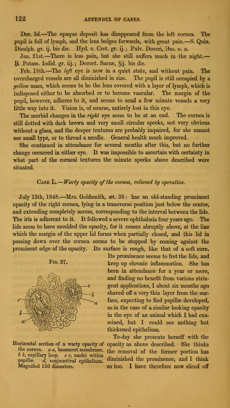 Dec. 3d.—The opaque deposit has disappeared from the left cornea. The pupil is full of lymph, and the lens bulges forwards, with great pain.—S. Quin. Disulph. gr. ij. bis die. Hyd. c. Cret. gr. ij.; Pulv. Doveri, 3ss. o. n. Jan. 21st.—There is less pain, but she still suffers much in the night.— P> Potass. lodid. gr. hj.; Decoct. Sarzae, §ij. bis die. Feb. 18th.—The left eye is now in a quiet state, and without pain. The overcharged vessels are all diminished in size. The pupil is still occupied by a yellow mass, which seems to be the lens covered with a layer of lymph, which is indisposed either to be absorbed or to become vascular. The margin of the pupil, however, adheres to it, and seems to send a few minute vessels a very little way into it. Vision is, of course, entirely lost in this eye. The morbid changes in the right eye seem to be at an end. The cornea is still dotted with dark brown and very small circular specks, not very obvious without a glass, and the deeper textures are probably impaired, for she cannot see small type, or to thread a needle. General health much improved. She continued in attendance for several months after this, but no farther change occurred in either eye. It was impossible to ascertain with certainty in what part of the corneal textures the minute specks above described were situated. Case L.—Warty opacity of the cornea, relieved by operation. July 13th, 1848.—Mrs. Goldsmith, set. 38 : has an old-standing prominent opacity of the right cornea, lying in a transverse position just below the centre, and extending completely across, corresponding to the interval between the lids. The iris is adherent to it. It followed a severe ophthalmia four years ago. The lids seem to have moulded the opacity, for it ceases abruptly above, at the line which the margin of the upper lid forms when partially closed, and this lid in passing down over the cornea seems to be stopped by coming against the prominent edge of the opacity. Its surface is rough, like that of a soft corn. Its prominence seems to fret the lids, and *IG* 37. keep up chronic inflammation. She has been in attendance for a year or more, and finding no benefit from various strin- gent applications, I about six months ago shaved off a very thin layer from the sur- face, expecting to find papillae developed, as in the case of a similar looking opacity in the eye of an animal which I had exa- mined, but I could see nothing but thickened epithelium. To-day she presents herself with the Horizontal section of a warty opacity of opacity as above described. She thinks the cornea, a a, basement membrane. the remoVal of the former portion has 0 0, capillary loop, c c, nuclei withm ,. . . , , ,, . r 1T ... . papilla, d, conjunctival epithelium, diminished the prominence, and I think Magnified 150 diameters. so too. I have therefore now sliced off