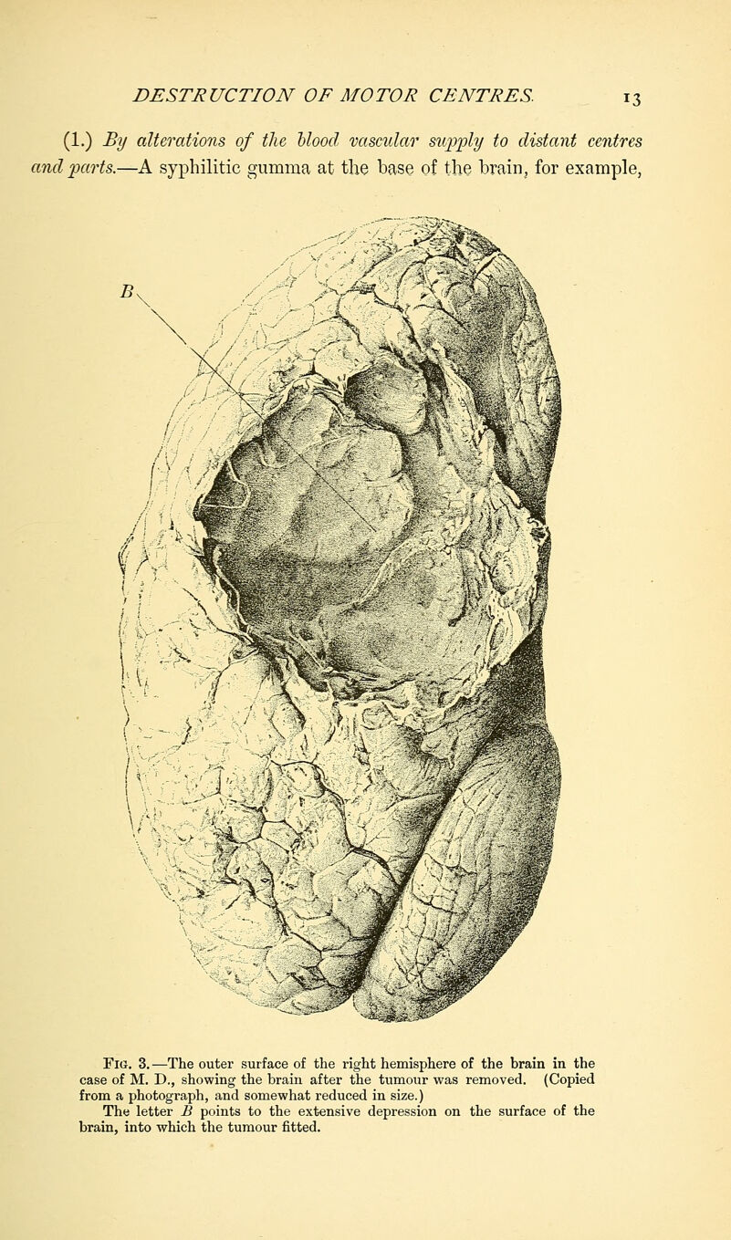 (1.) By alterations of the blood vascular supply to distant centres and parts.—A syphilitic gumma at the base of the brain, for example, Fid. 3.—The outer surface of the right hemisphere of the brain in the case of M. D., showing the brain after the tumour was removed. (Copied from a photograph, and somewhat reduced in size.) The letter B points to the extensive depression on the surface of the brain, into which the tumour fitted.