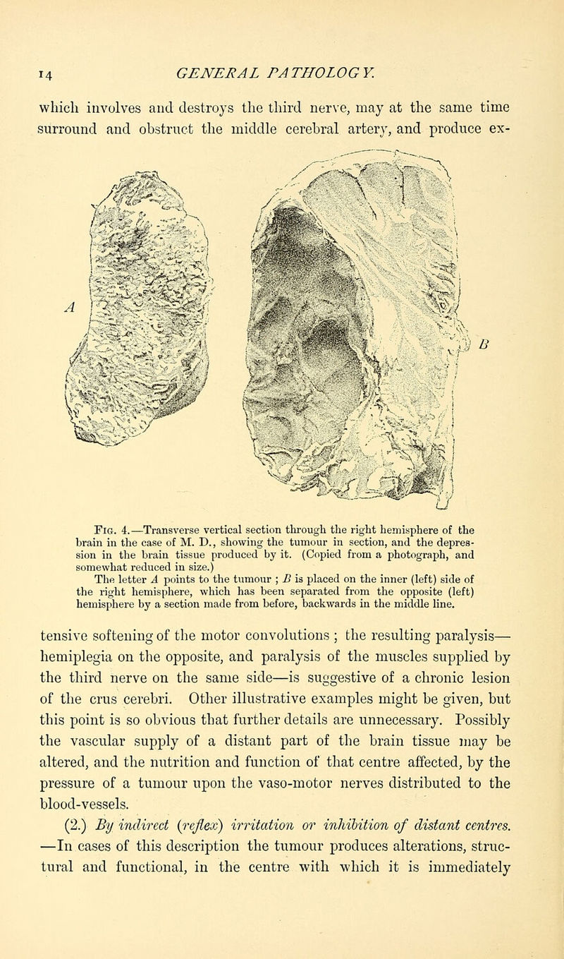 which involves and destroys the third nerve, may at the same time surround and obstruct the middle cerebral artery, and produce ex- sfifiBt* •  ,_l~-5m5 i*■■*?*'■}•: -,- * '-S ■■■? li 5 Tig. 4.—Transverse vertical section through the right hemisphere of the brain in the case of M. D., showing the tumour in section, and the depres- sion in the brain tissue produced by it. (Copied from a photograph, and somewhat reduced in size.) The letter A points to the tumour ; B is placed on the inner (left) side of the right hemisphere, which has been separated from the opposite (left) hemisphere by a section made from before, backwards in the middle line. tensive softening of the motor convolutions ; the resulting paralysis— hemiplegia on the opposite, and paralysis of the muscles supplied by the third nerve on the same side—is suggestive of a chronic lesion of the crus cerebri. Other illustrative examples might be given, but this point is so obvious that further details are unnecessary. Possibly the vascular supply of a distant part of the brain tissue may be altered, and the nutrition and function of that centre affected, by the pressure of a tumour upon the vaso-motor nerves distributed to the blood-vessels. (2.) By indirect {reflex) irritation or inhibition of distant centres. —In cases of this description the tumour produces alterations, struc- tural and functional, in the centre with which it is immediately