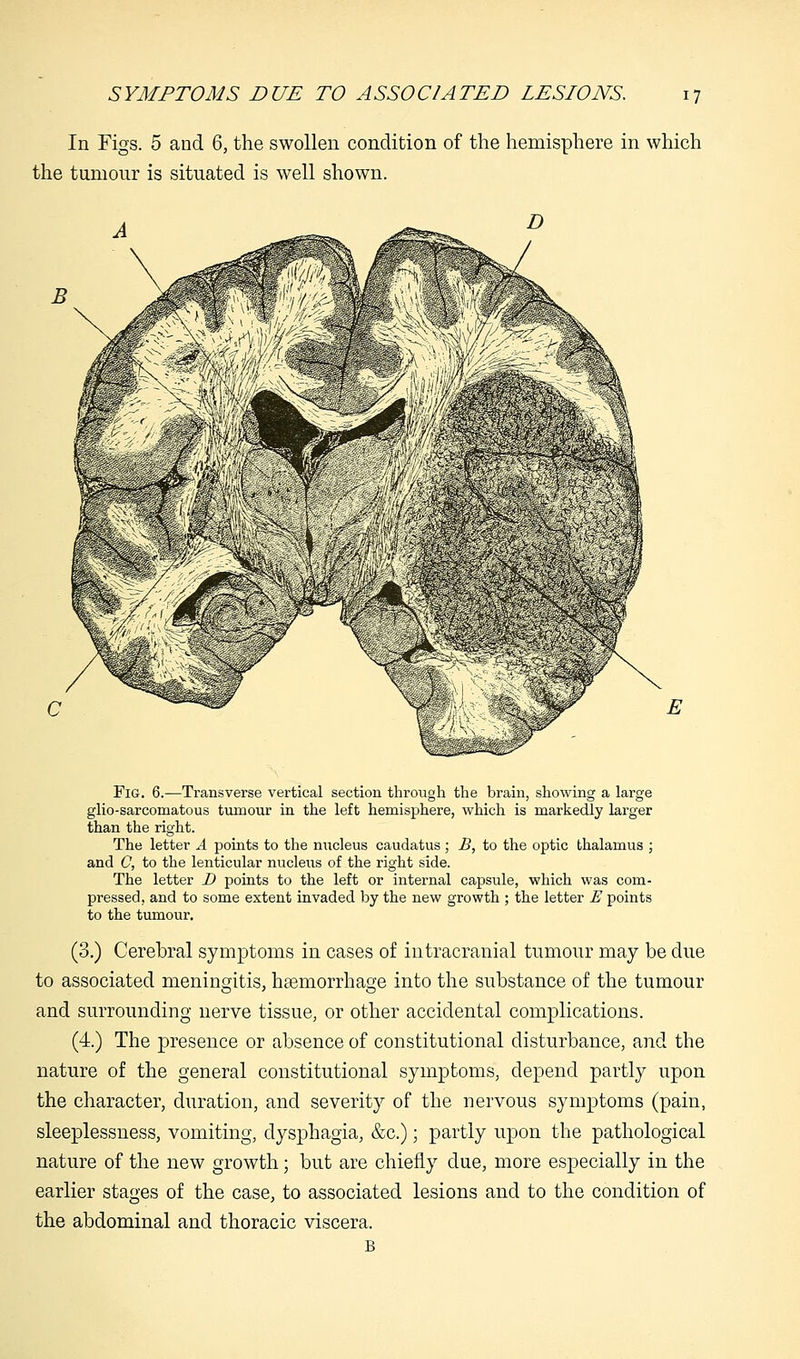 In Figs. 5 and 6, the swollen condition of the hemisphere in which the tumour is situated is well shown. fWmi I fcl^ —' If 1^ c ft' £ Fig. 6.—Transverse vertical section through the brain, showing a large glio-sarcomatous tumour in the left hemisphere, which is markedly larger than the right. The letter A points to the nucleus caudatus ; B, to the optic thalamus ; and C, to the lenticular nucleus of the right side. The letter D points to the left or internal capsule, which was com- pressed, and to some extent invaded by the new growth ; the letter E points to the tumour. (3.) Cerebral symptoms in cases of intracranial tumour may be due to associated meningitis, haemorrhage into the substance of the tumour and surrounding nerve tissue, or other accidental complications. (4.) The presence or absence of constitutional disturbance, and the nature of the general constitutional symptoms, depend partly upon the character, duration, and severity of the nervous symptoms (pain, sleeplessness, vomiting, dysphagia, &c.); partly upon the pathological nature of the new growth; but are chiefly due, more especially in the earlier stages of the case, to associated lesions and to the condition of the abdominal and thoracic viscera. B