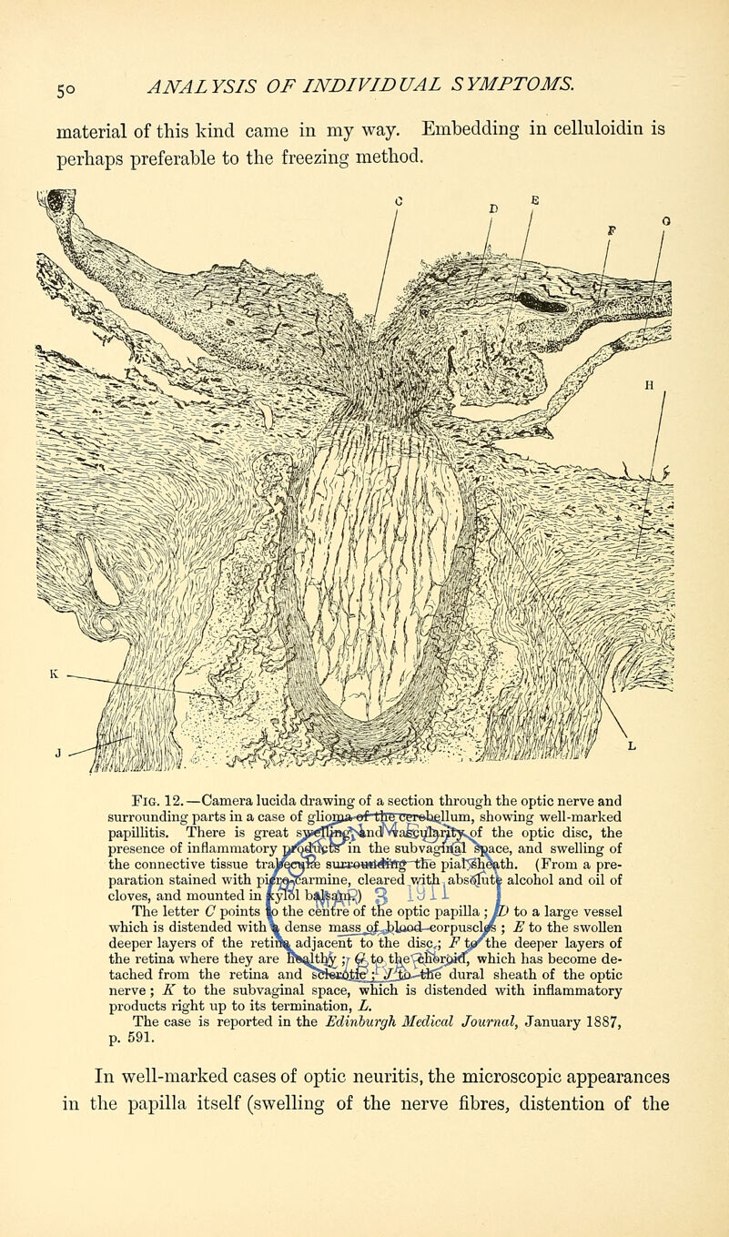 5° material of this kind came in my way. Embedding in celluloidin is perhaps preferable to the freezing method. Fig. 12.—Camera lucida drawing of a section through the optic nerve and surrounding parts in a case of gliomar-of' lire uereheUum, showing well-marked papillitis. There is great s\s«#l*iK^ndN?a®ufei^y^of the optic disc, the presence of inflammatory pfforafcrS*^in the sub vaginal soace, and swelling of the connective tissue tral^cTiKe suEEetwWBftg-the piat$§heath. (From a pre- paration stained with p^^carmine, cleared with abs©Jut| alcohol and oil of cloves, and mounted in Kylol balfea(fc£>) ^ 1 a 11 The letter C points lo the centre of the optic papilla ; tD to a large vessel which is distended with\ dense mass^of^^lflod^eorpuscl^ ; E to the swollen deeper layers of the retina adjacent to the discr; F tprihe deeper layers of the retina where they are nSalth^;r^tpthe^nforjjkf, which has become de- tached from the retina and sci«j^^j£yiji0--the dural sheath of the optic nerve; K to the subvaginal space, which is distended with inflammatory products right up to its termination, L. The case is reported in the Edinburgh Medical Journal, January 1887, p. 591. In well-marked cases of optic neuritis, the microscopic appearances in the papilla itself (swelling of the nerve fibres, distention of the