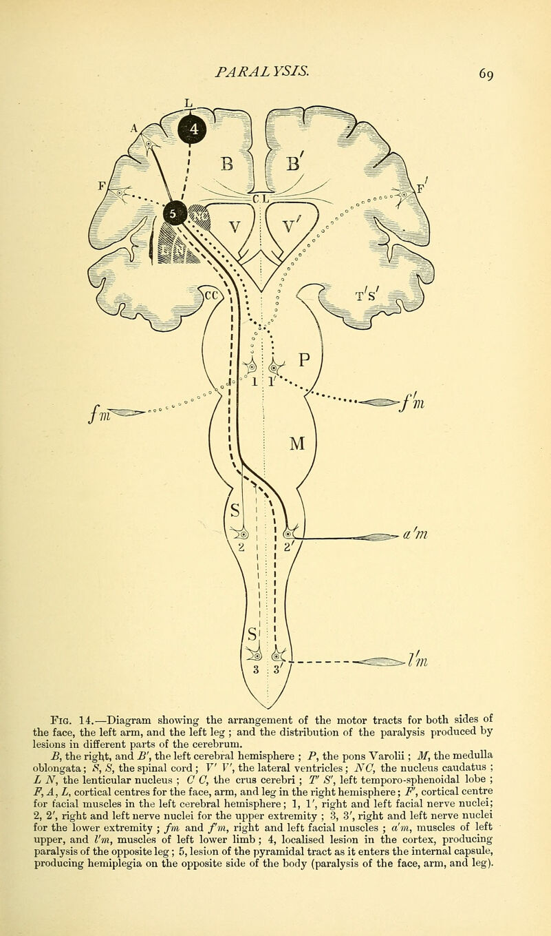 Fig. 14.—Diagram showing the arrangement of the motor tracts for both sides of the face, the left arm, and the left leg ; and the distribution of the paralysis produced by lesions in different parts of the cerebrum. B, the right, and B', the left cerebral hemisphere ; P, the pons Varolii; M, the medulla oblongata; S, S, the spinal cord ; V V, the lateral ventricles; NO, the nucleus caudatus ; L N, the lenticular nucleus ; C C, the crus cerebri; T' S', left temporo-sphenoidal lobe ; F,A,L, cortical centres for the face, arm, and leg in the right hemisphere; F', cortical centre for facial muscles in the left cerebral hemisphere; 1, 1', right and left facial nerve nuclei; 2, 2', right and left nerve nuclei for the upper extremity ; 3, 3', right and left nerve nuclei for the lower extremity ; fm and fm, right and left facial muscles ; a'm, muscles of left upper, and I'm, muscles of left lower limb; 4, localised lesion in the cortex, producing paralysis of the opposite leg; 5, lesion of the pyramidal tract as it enters the internal capsule, producing hemiplegia on the opposite side of the body (paralysis of the face, arm, and leg).